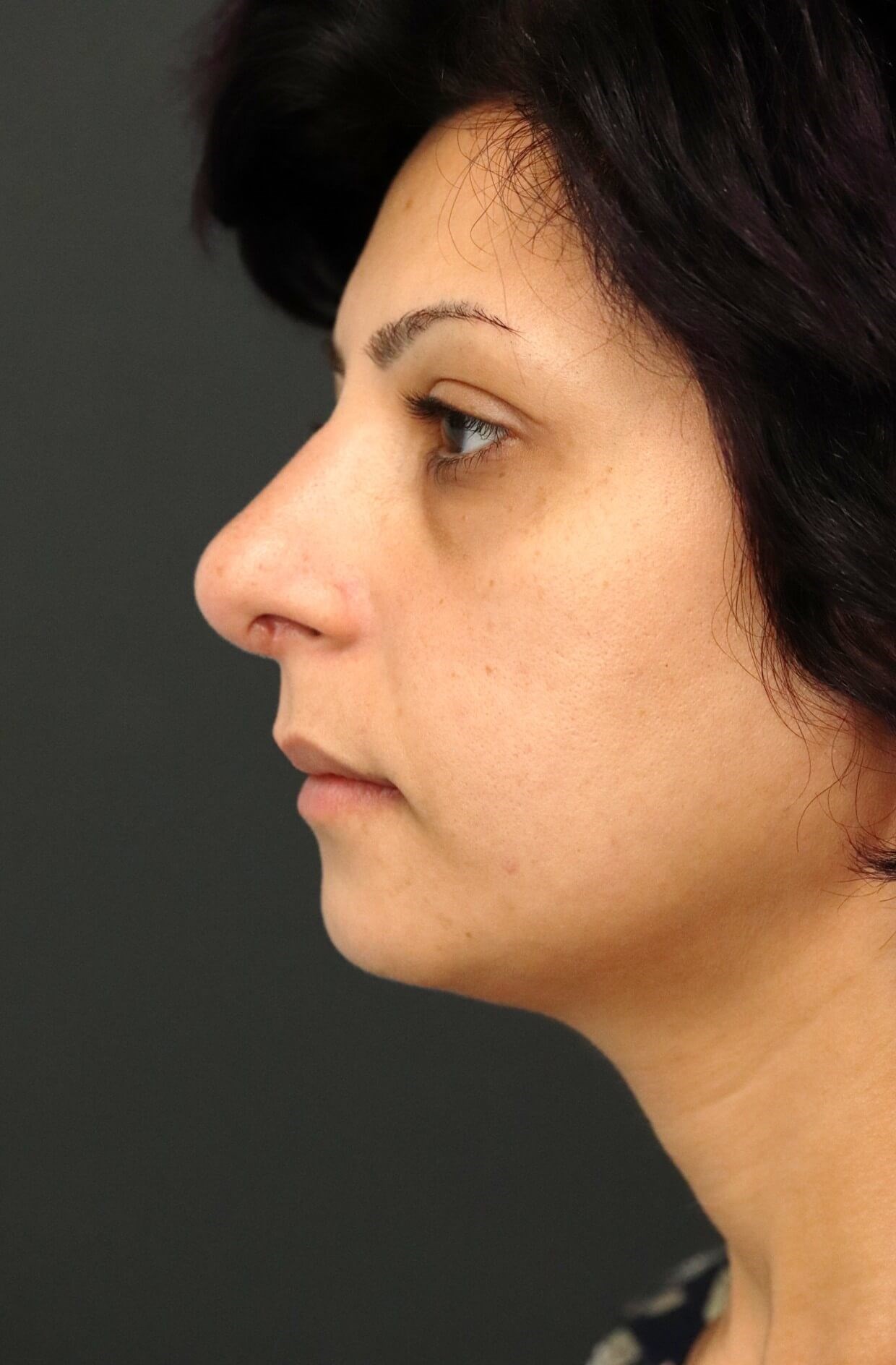 Rhinoplasty Dorsal reduction After