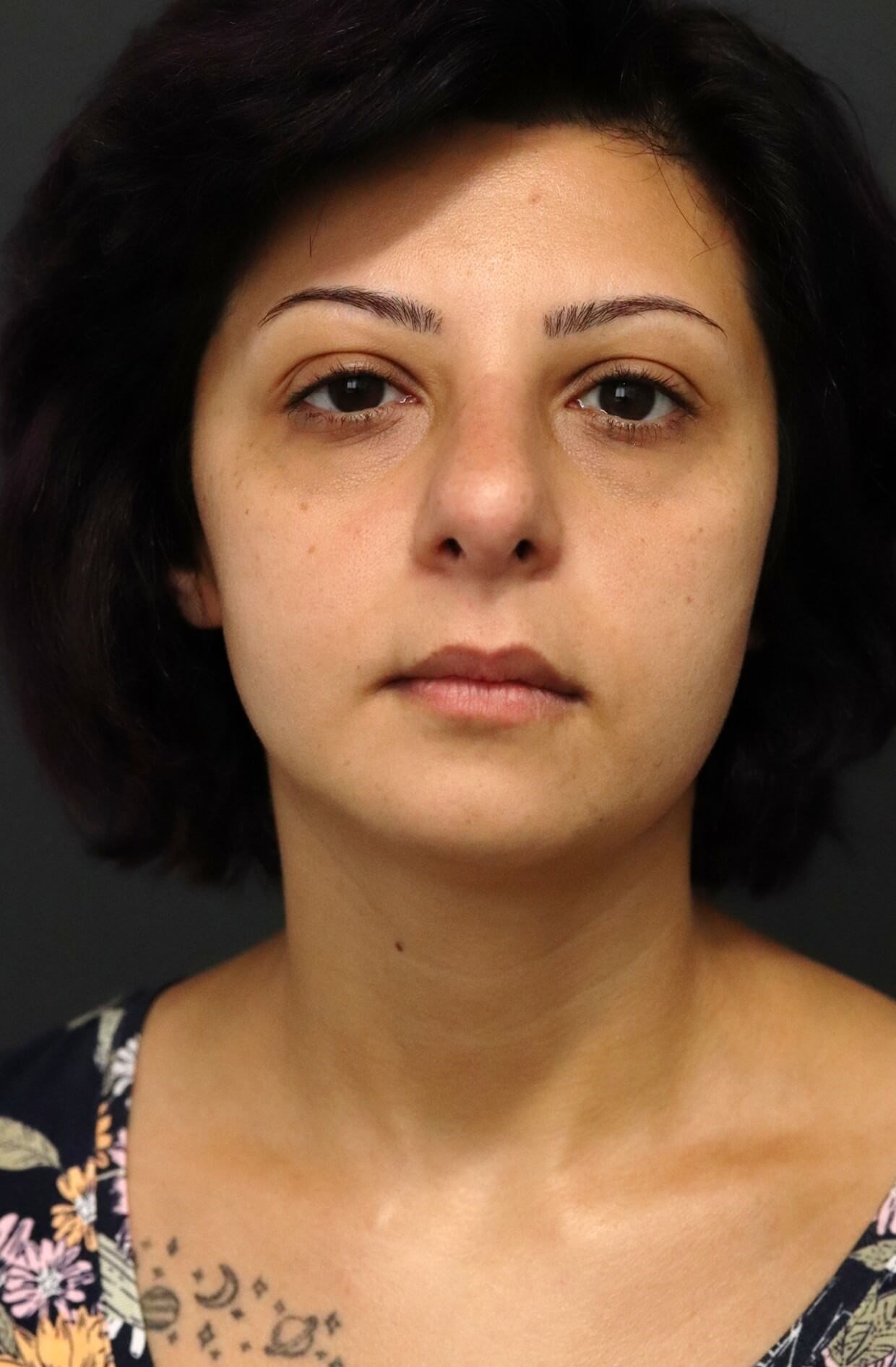 Nosejob Before and After After