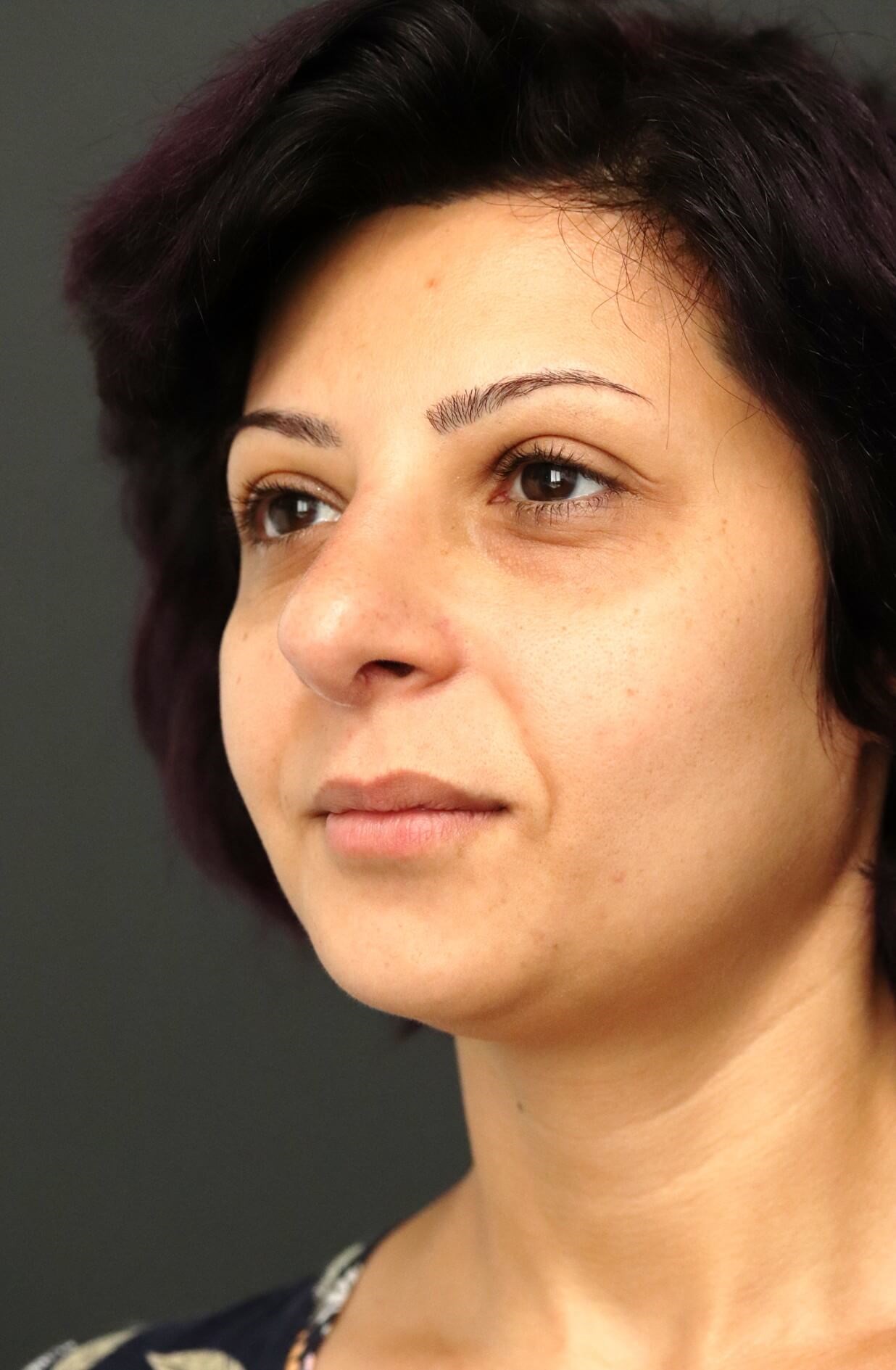 Open Rhinoplasty Dr. Levesque After