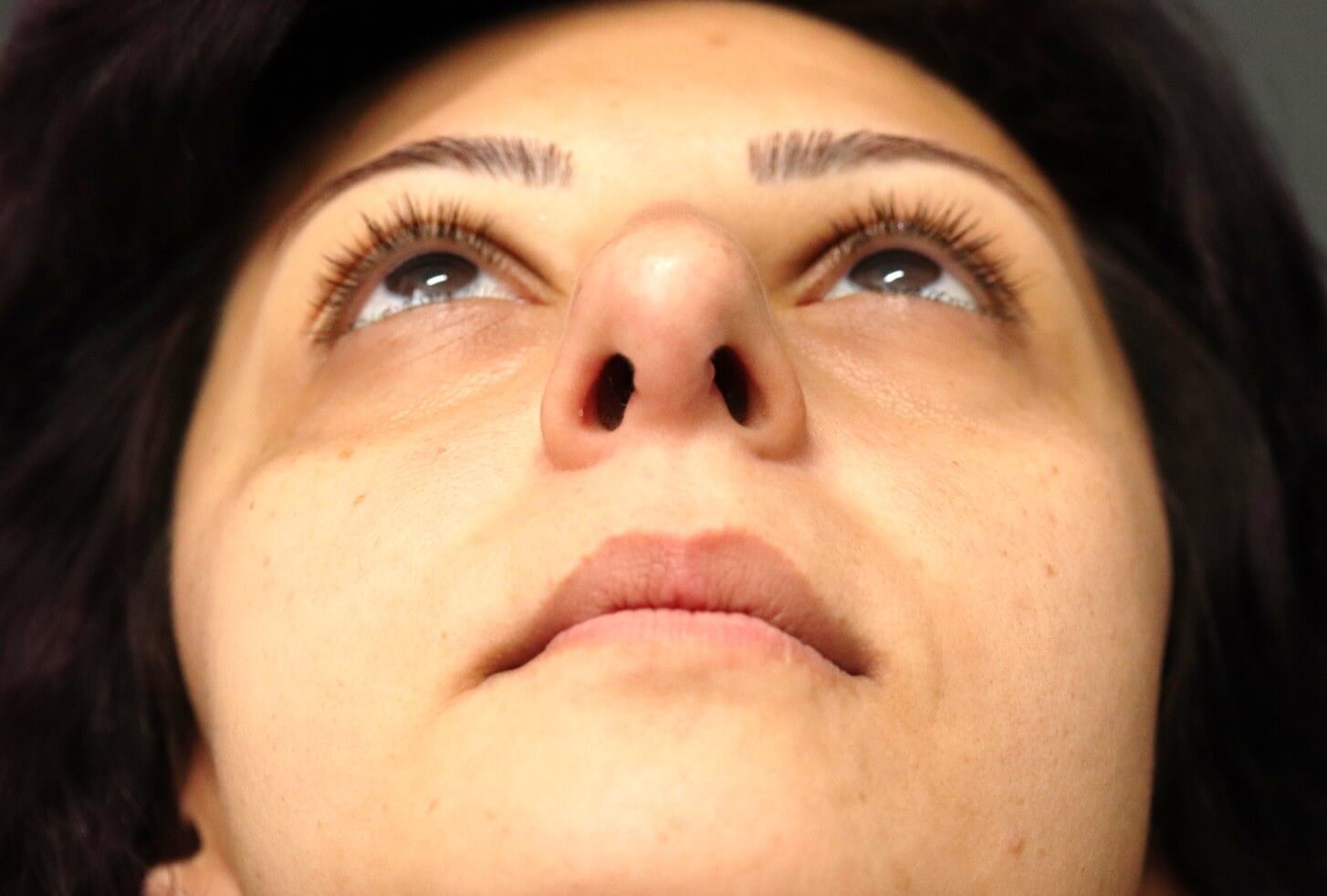 Open Rhinoplasty Austin Texas After