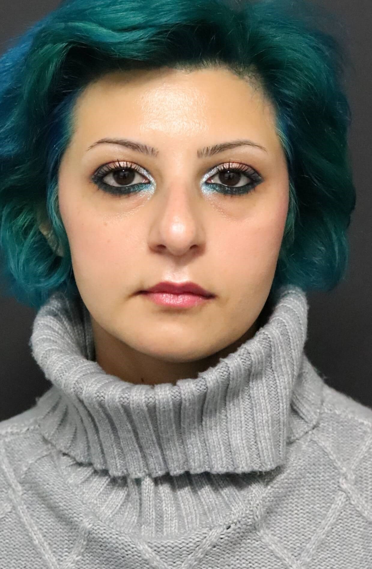Nosejob Before and After Before