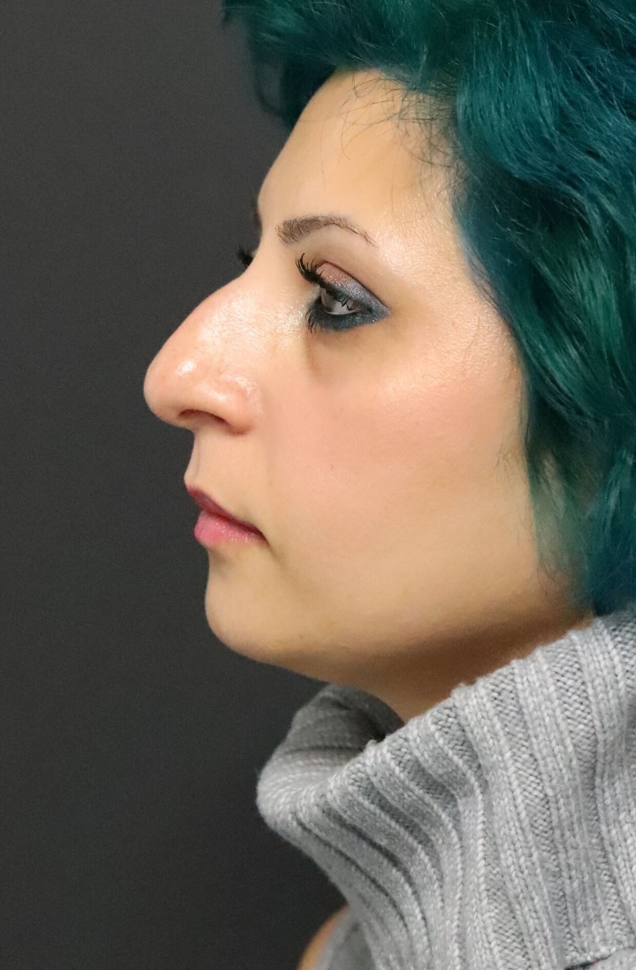 Rhinoplasty Dorsal reduction Before