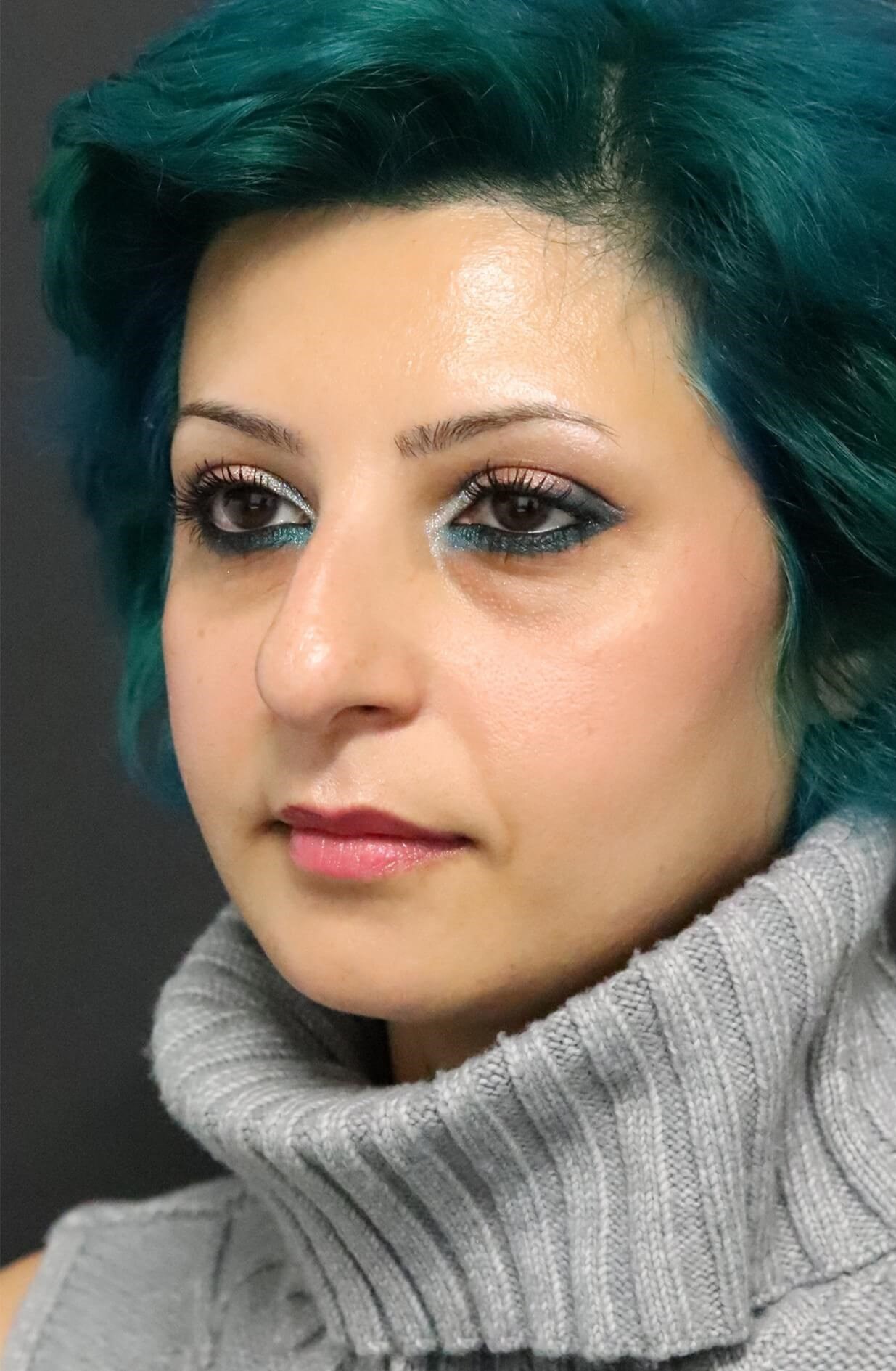 Open Rhinoplasty Dr. Levesque Before