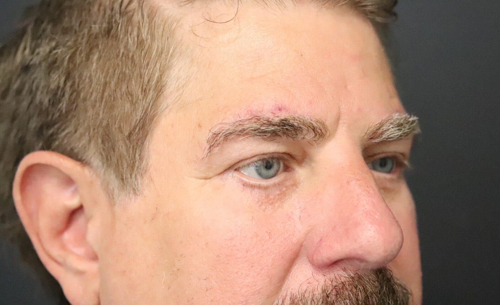Direct brow lift and lower lid After