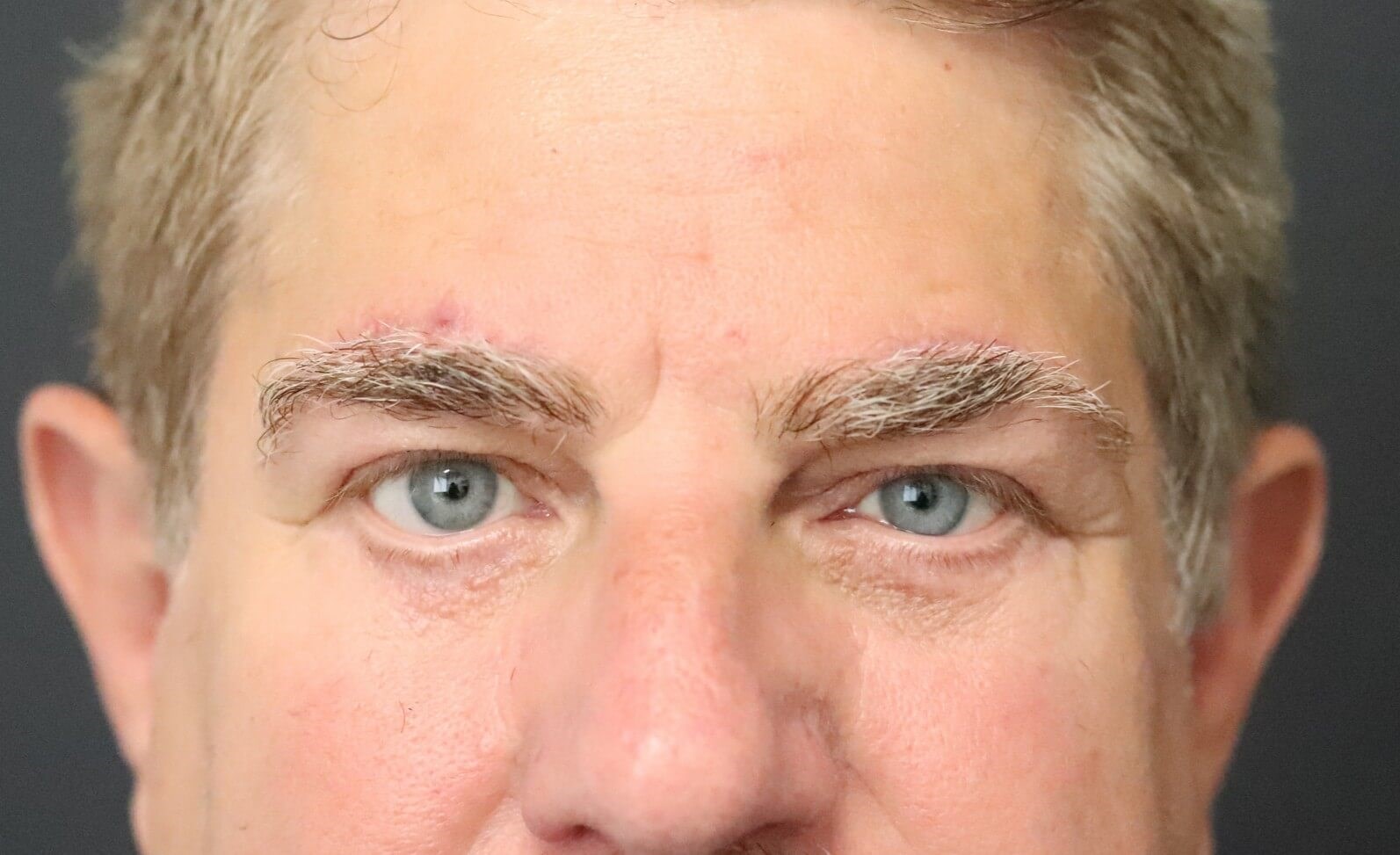 Direct brow lift and lower lid After