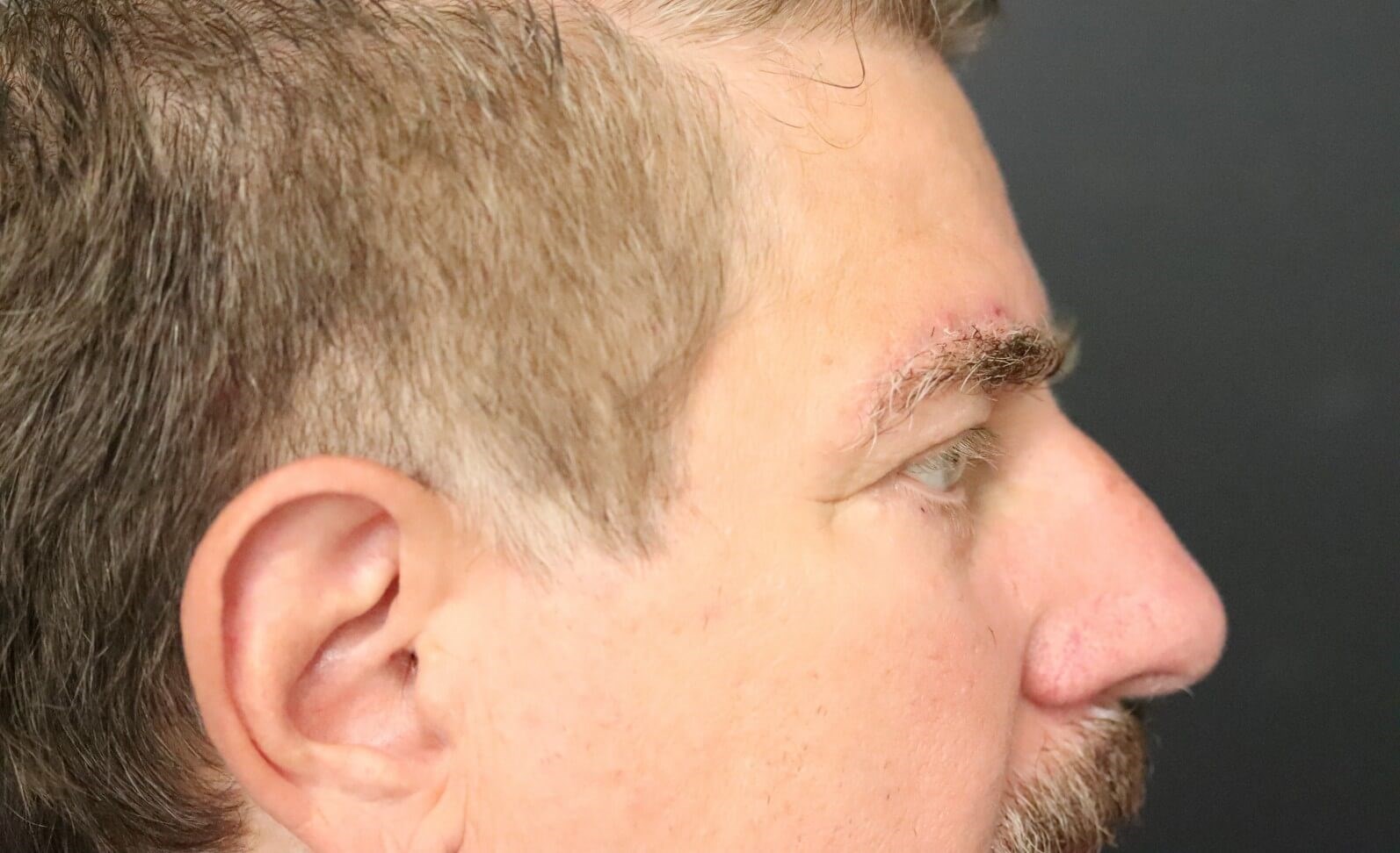 Direct brow lift and lower lid After