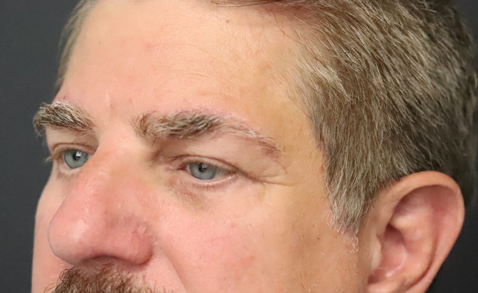 Direct brow lift and lower lid After