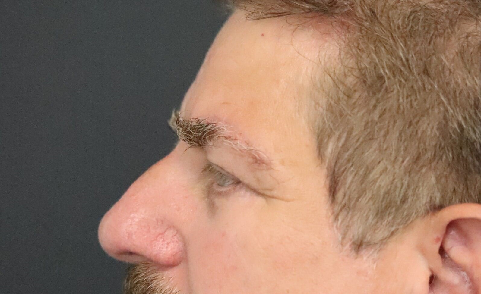 Direct brow lift and lower lid After