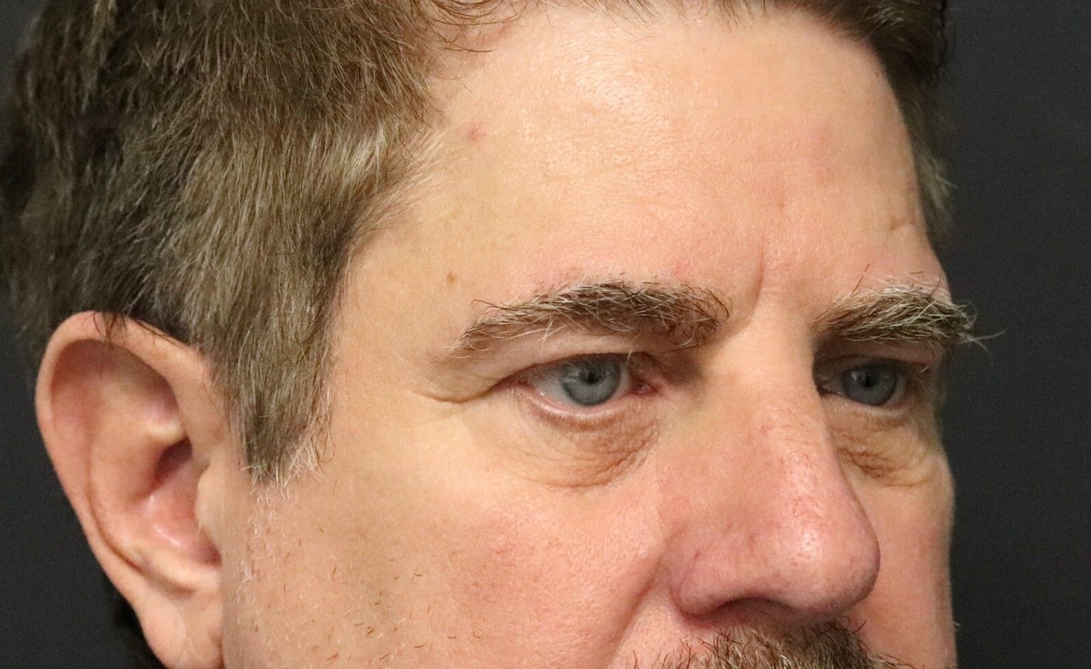 Direct brow lift and lower lid Before