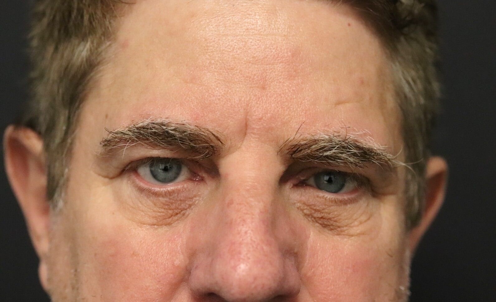 Direct brow lift and lower lid Before
