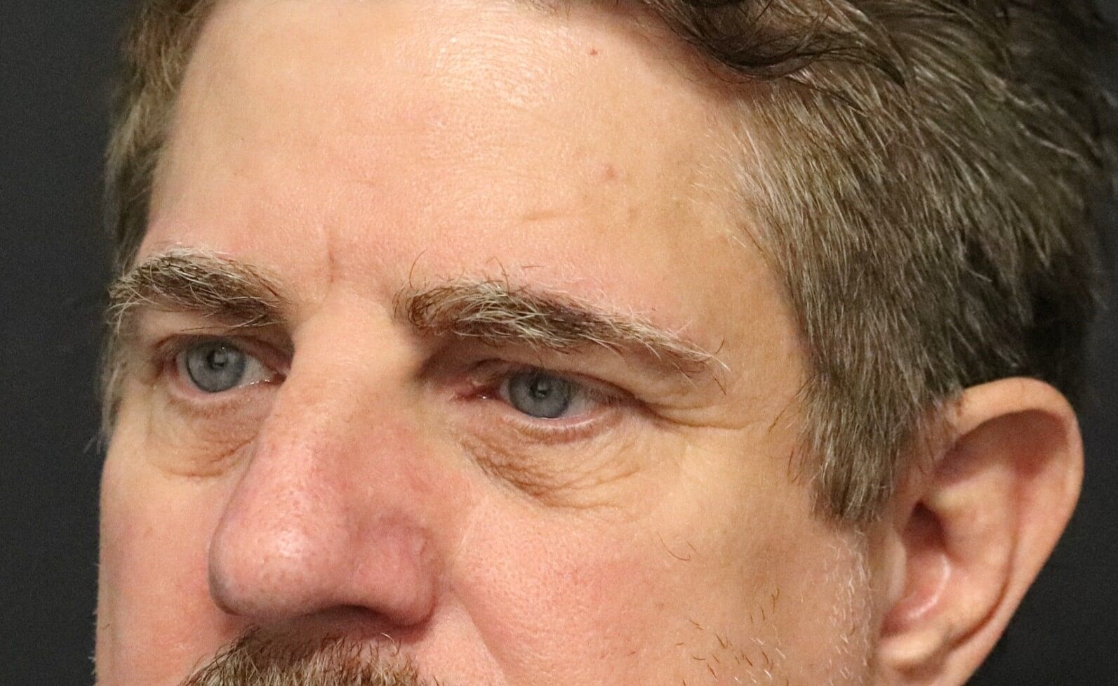 Direct brow lift and lower lid Before