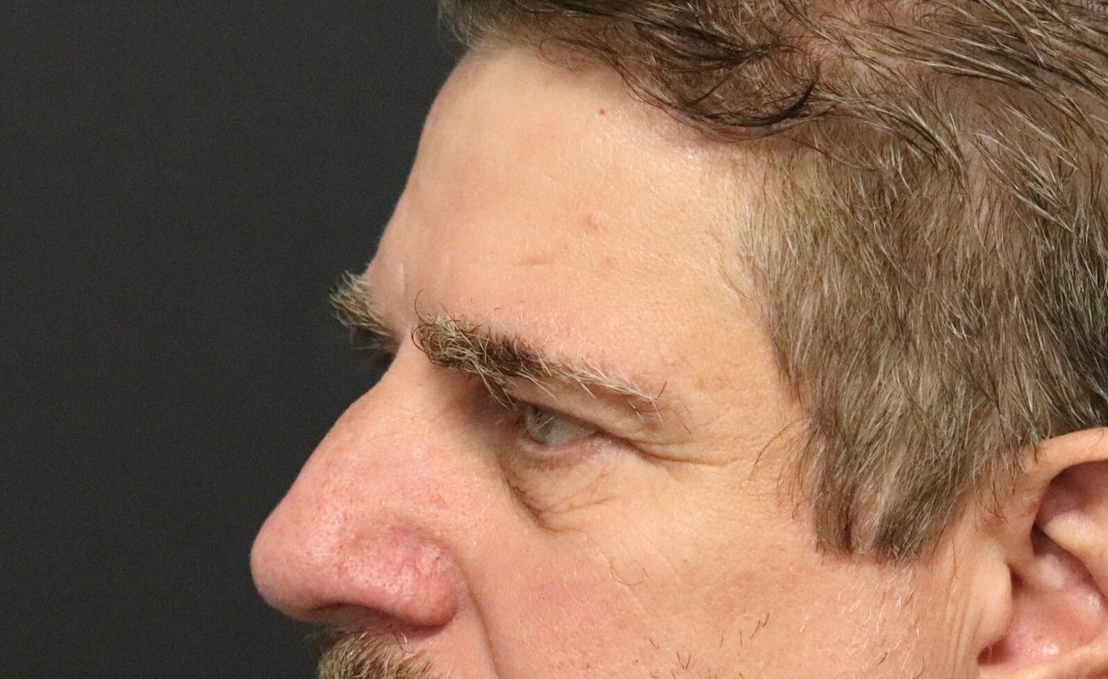 Direct brow lift and lower lid Before