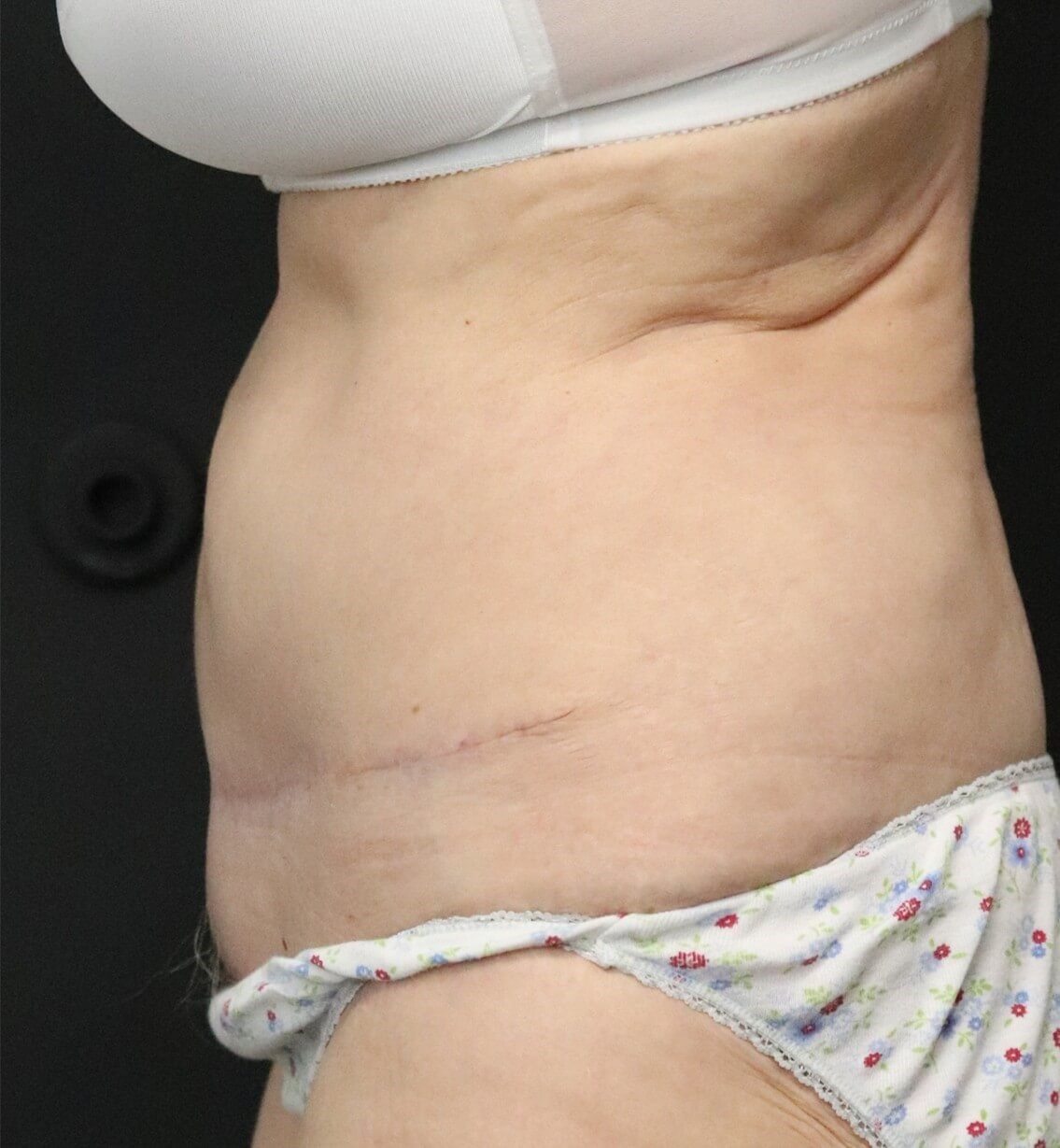 Tummy tuck with Liposuction After