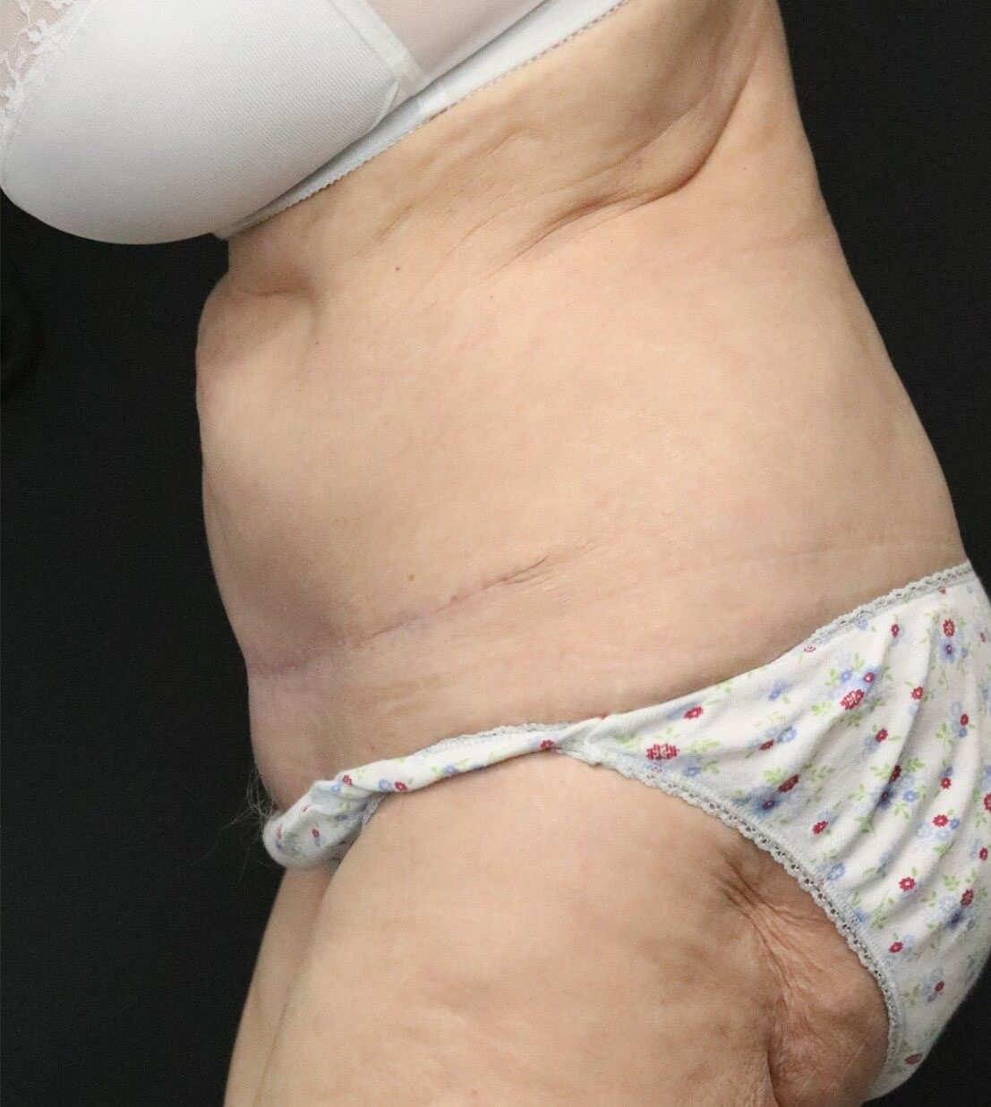 Tummy tuck with Liposuction After