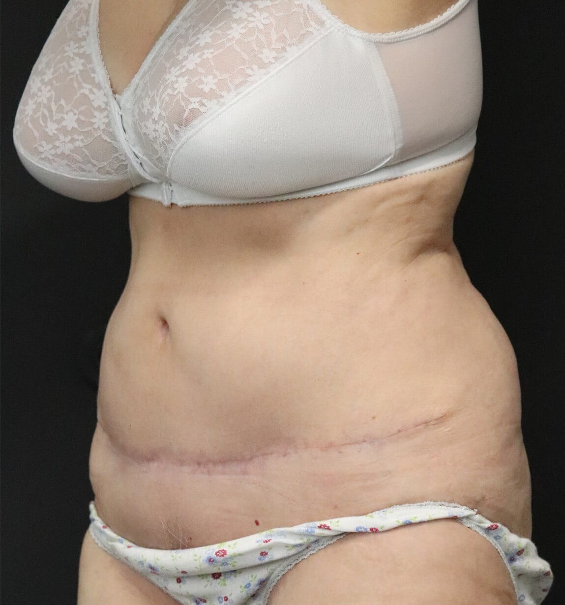 Tummy tuck with Liposuction After