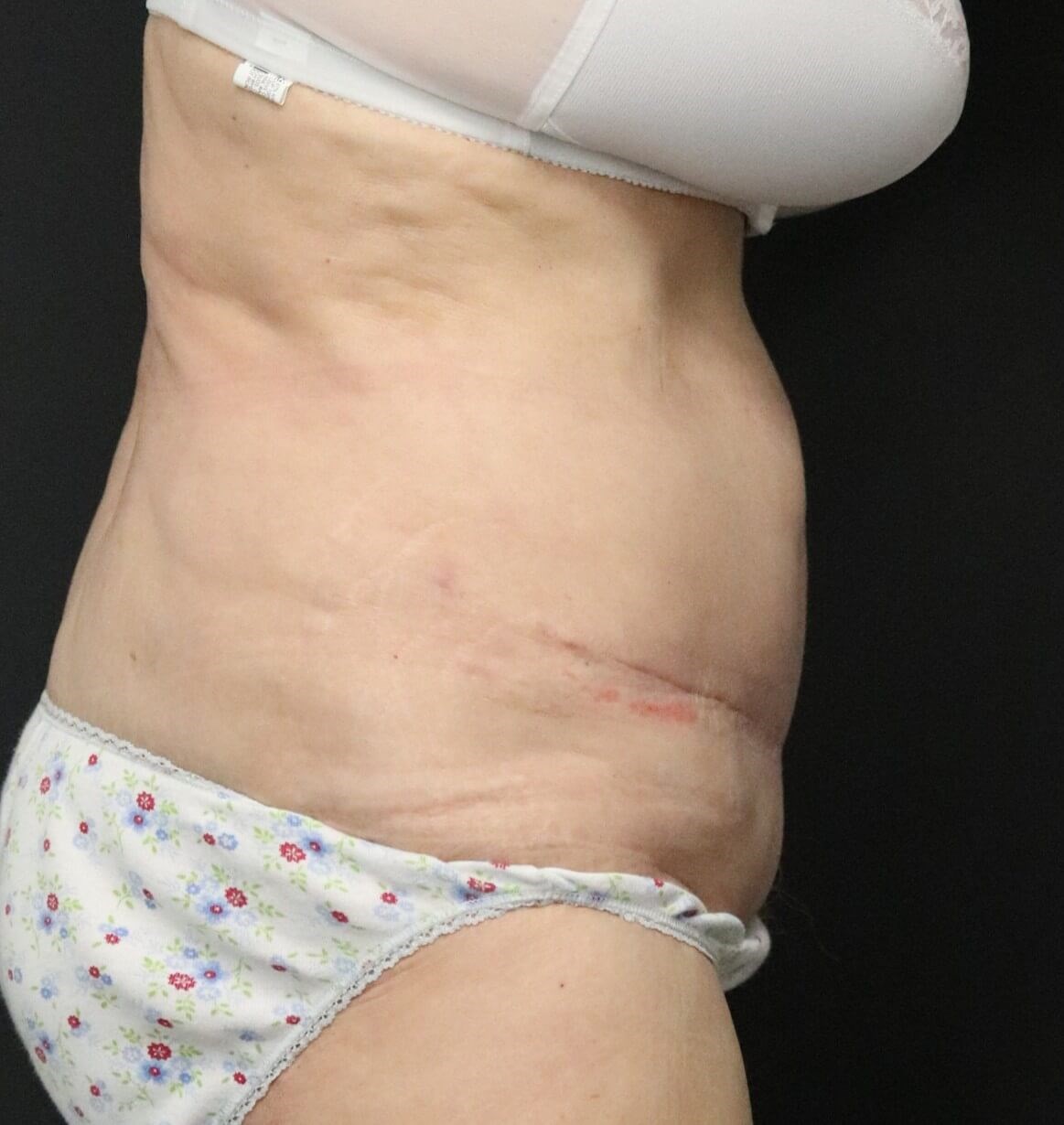 Tummy tuck with Liposuction After