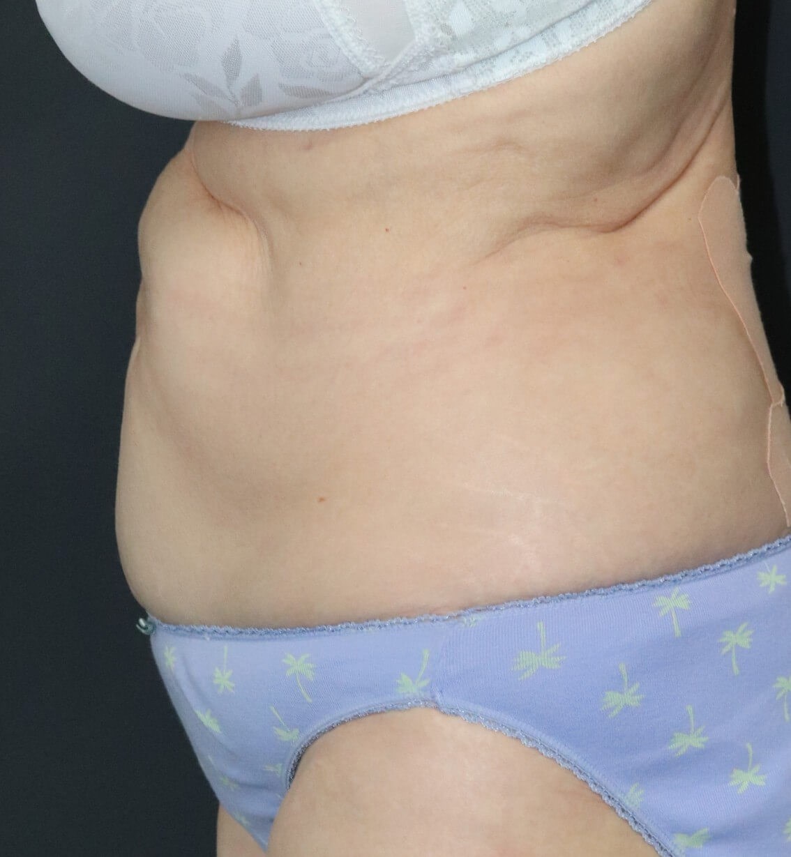 Tummy tuck with Liposuction Before