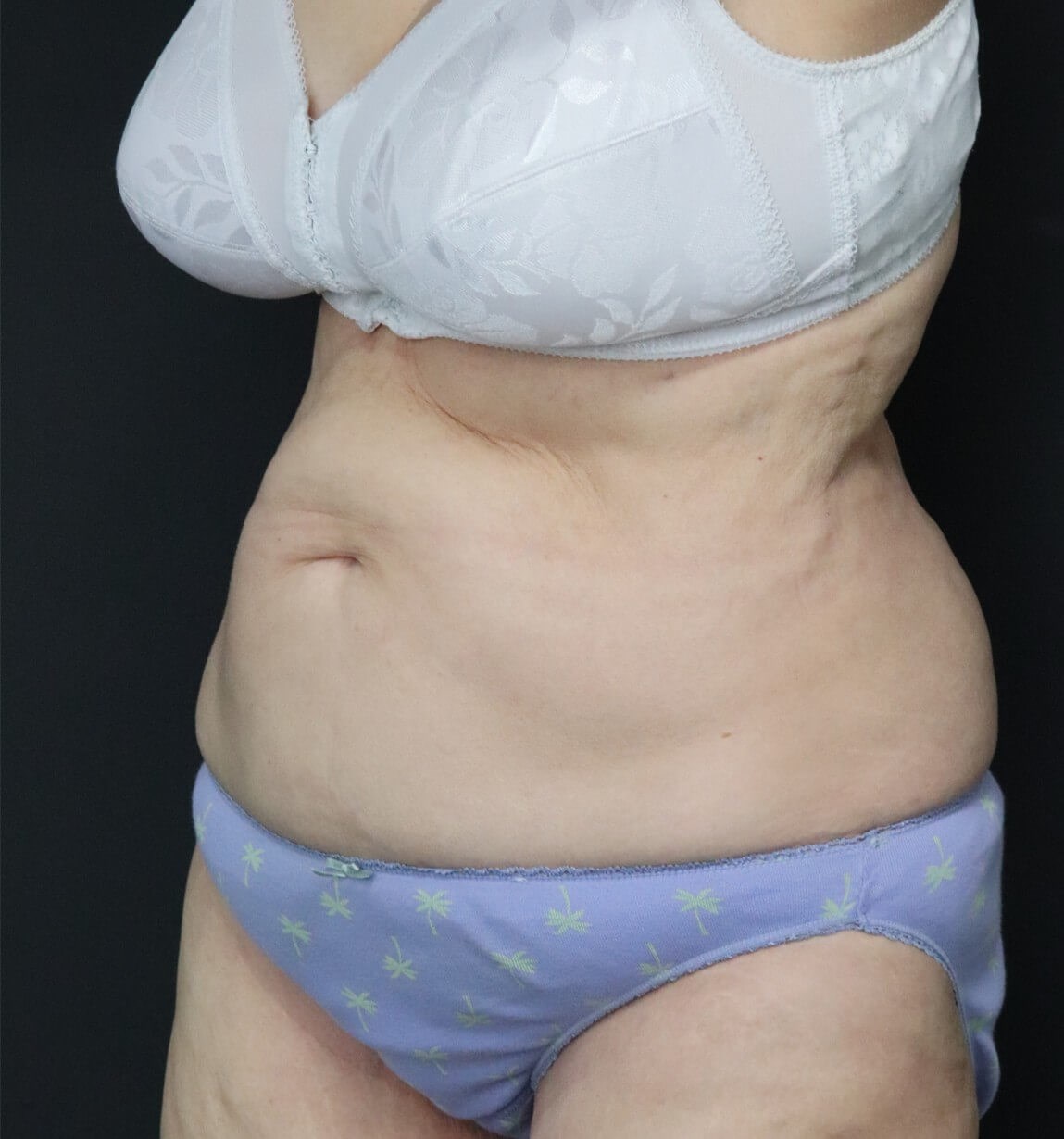 Tummy tuck with Liposuction Before
