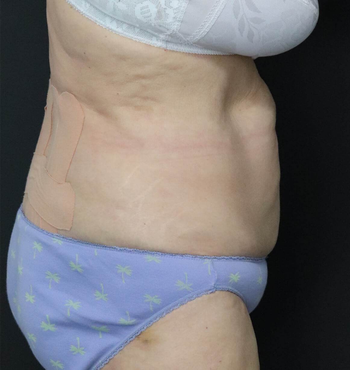 Tummy tuck with Liposuction Before
