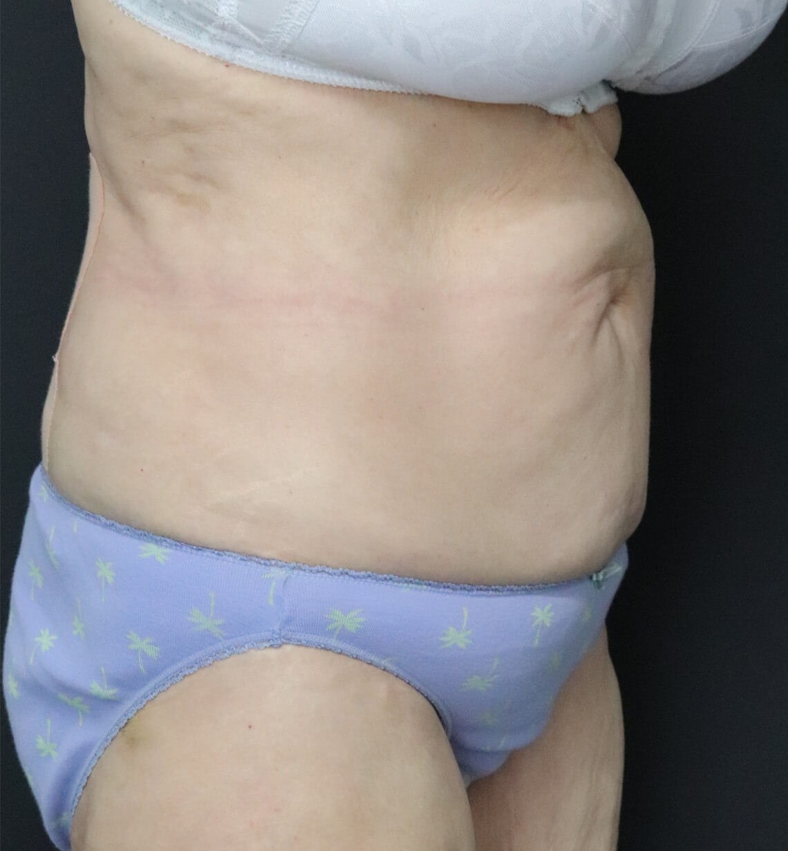 Tummy tuck with Liposuction Before