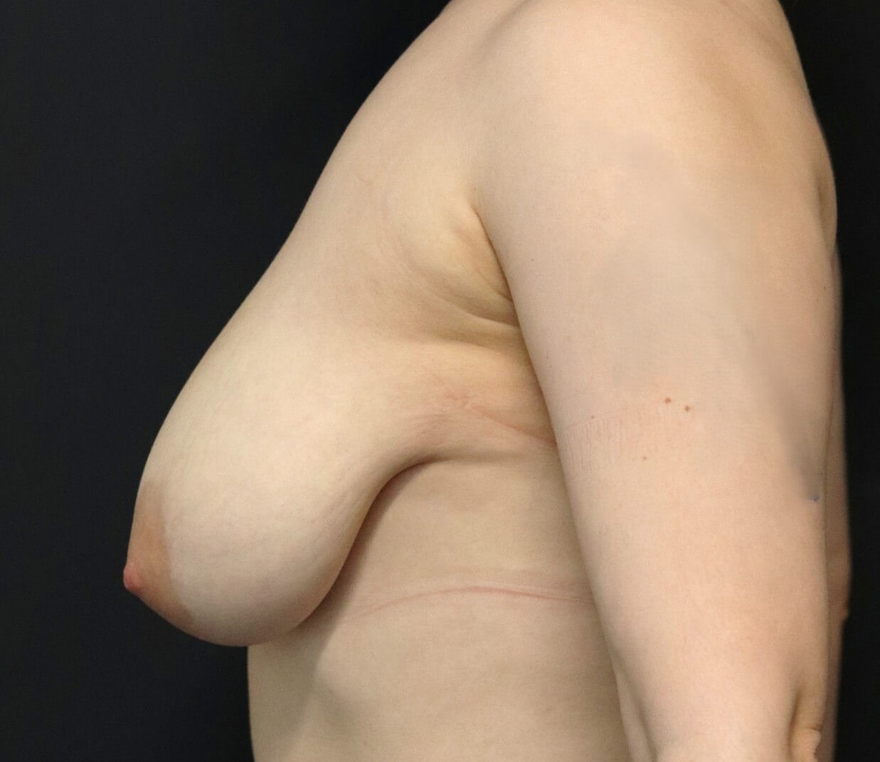 Breast Reduction Before