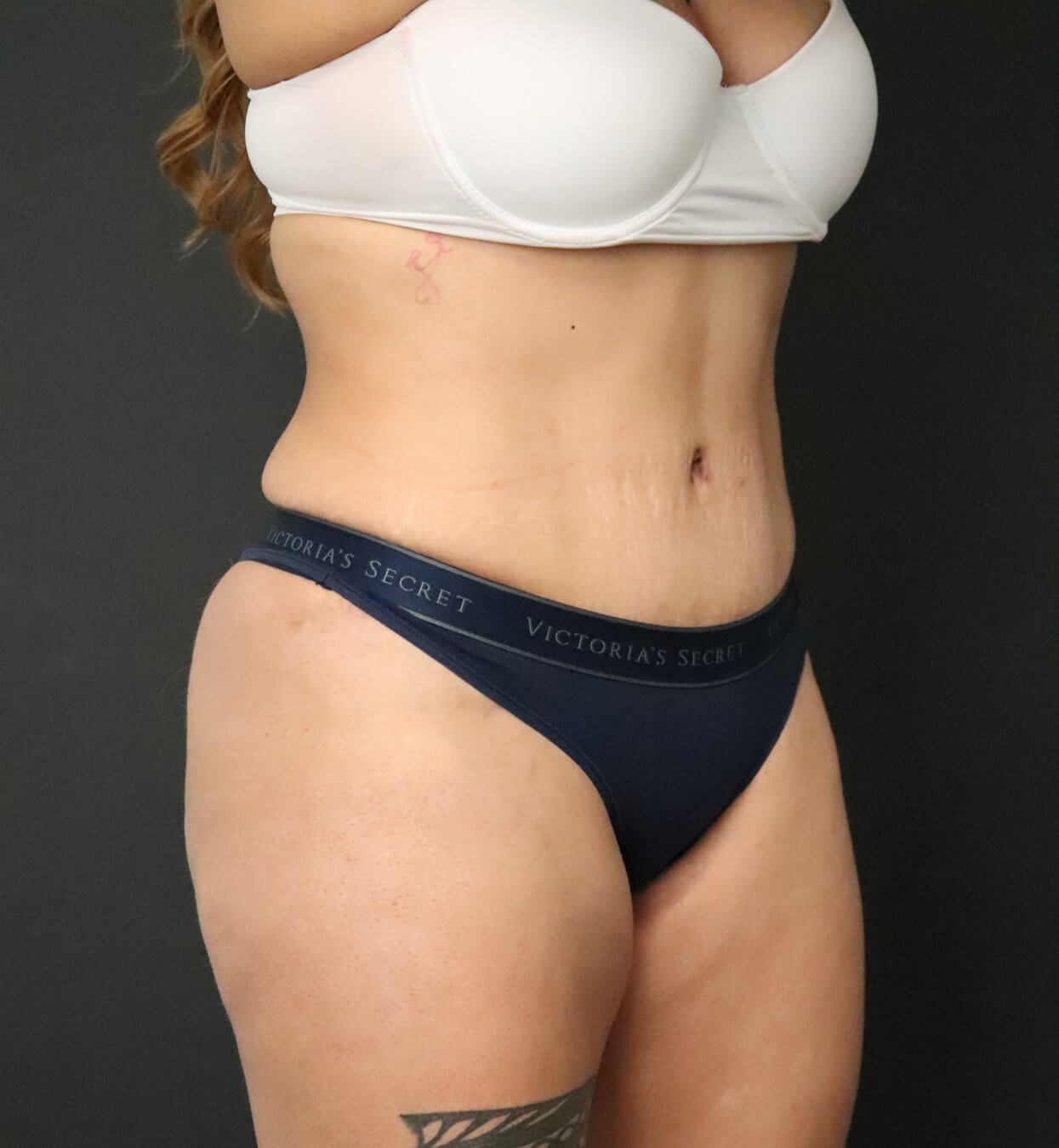 Lipo360 and Lipoabdominoplasty After