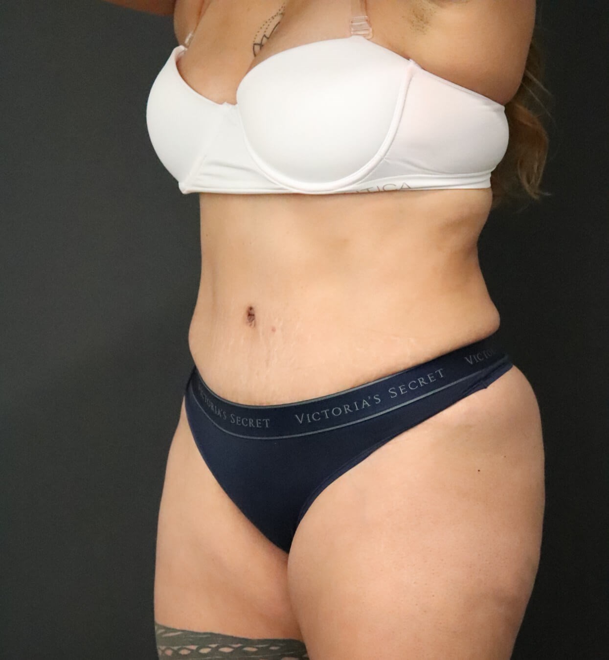 Lipo360 and Lipoabdominoplasty After