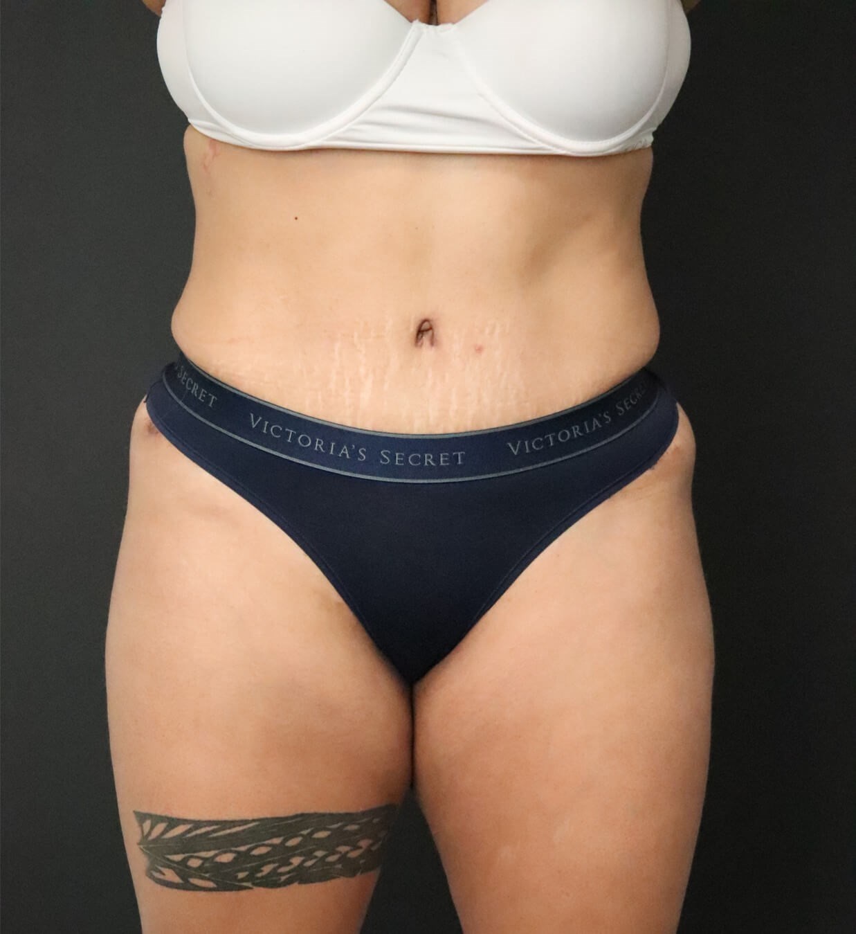 Lipo360 and Lipoabdominoplasty After