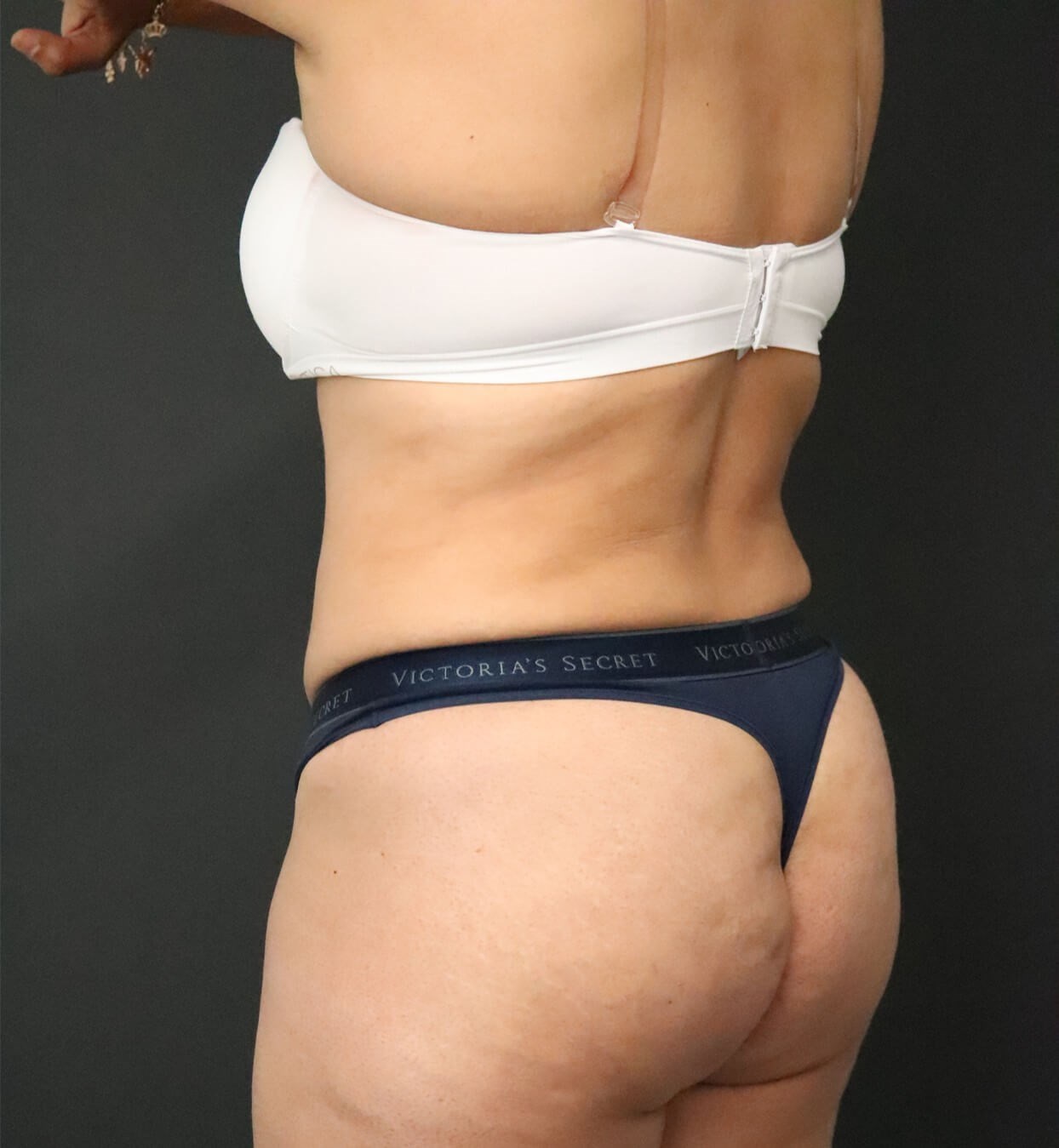 Lipo360 and Lipoabdominoplasty After