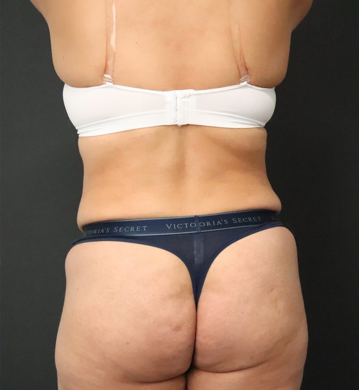 Lipo360 and Lipoabdominoplasty After