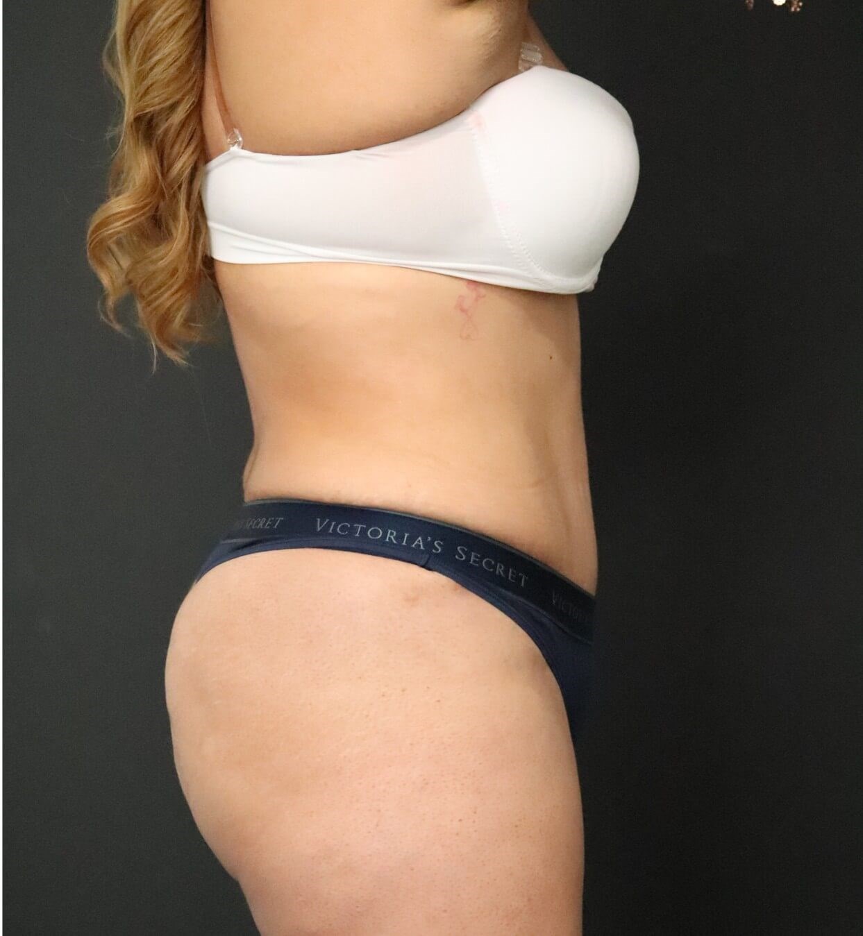 Lipo360 and Lipoabdominoplasty After