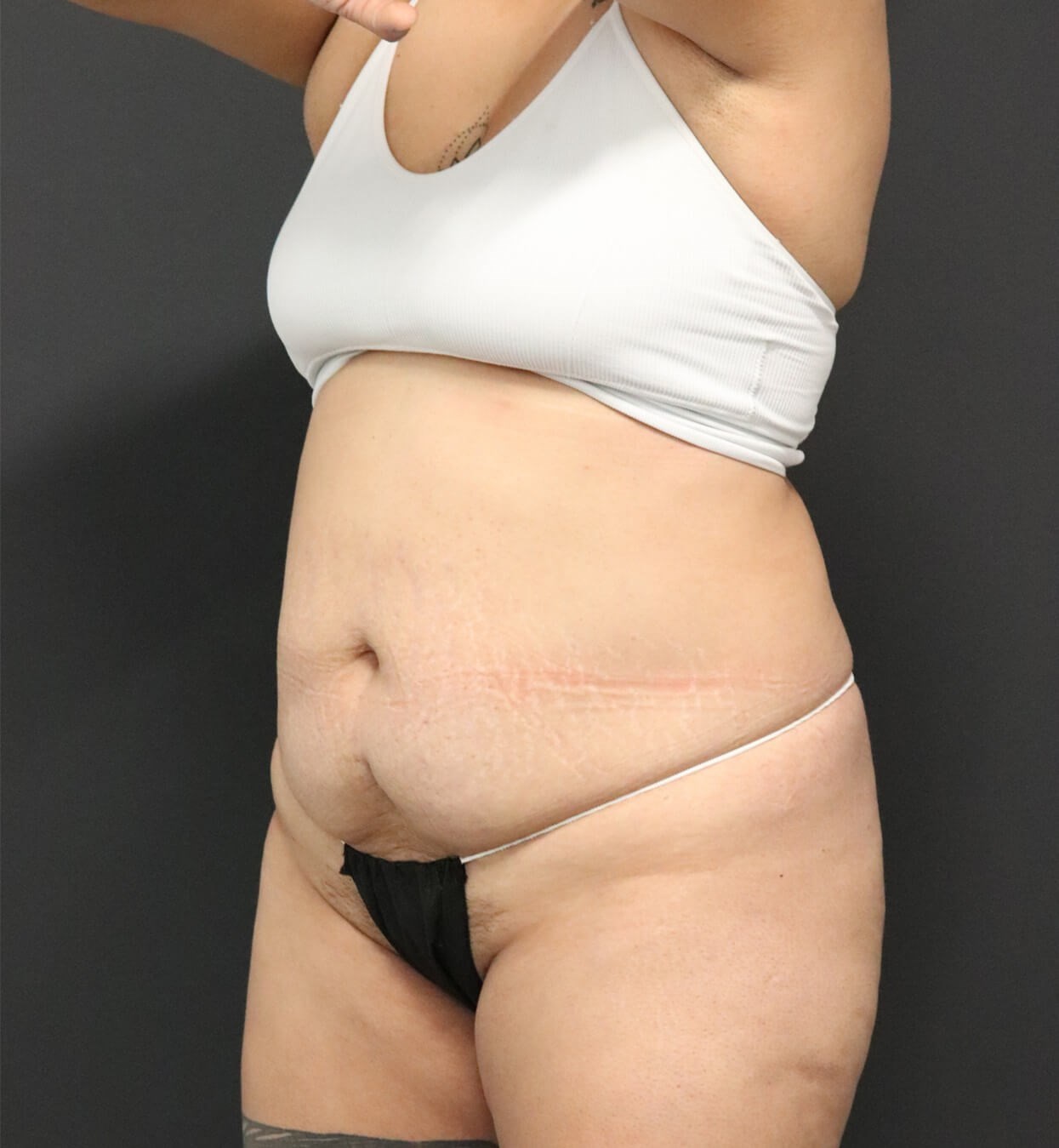 Lipo360 and Lipoabdominoplasty Before