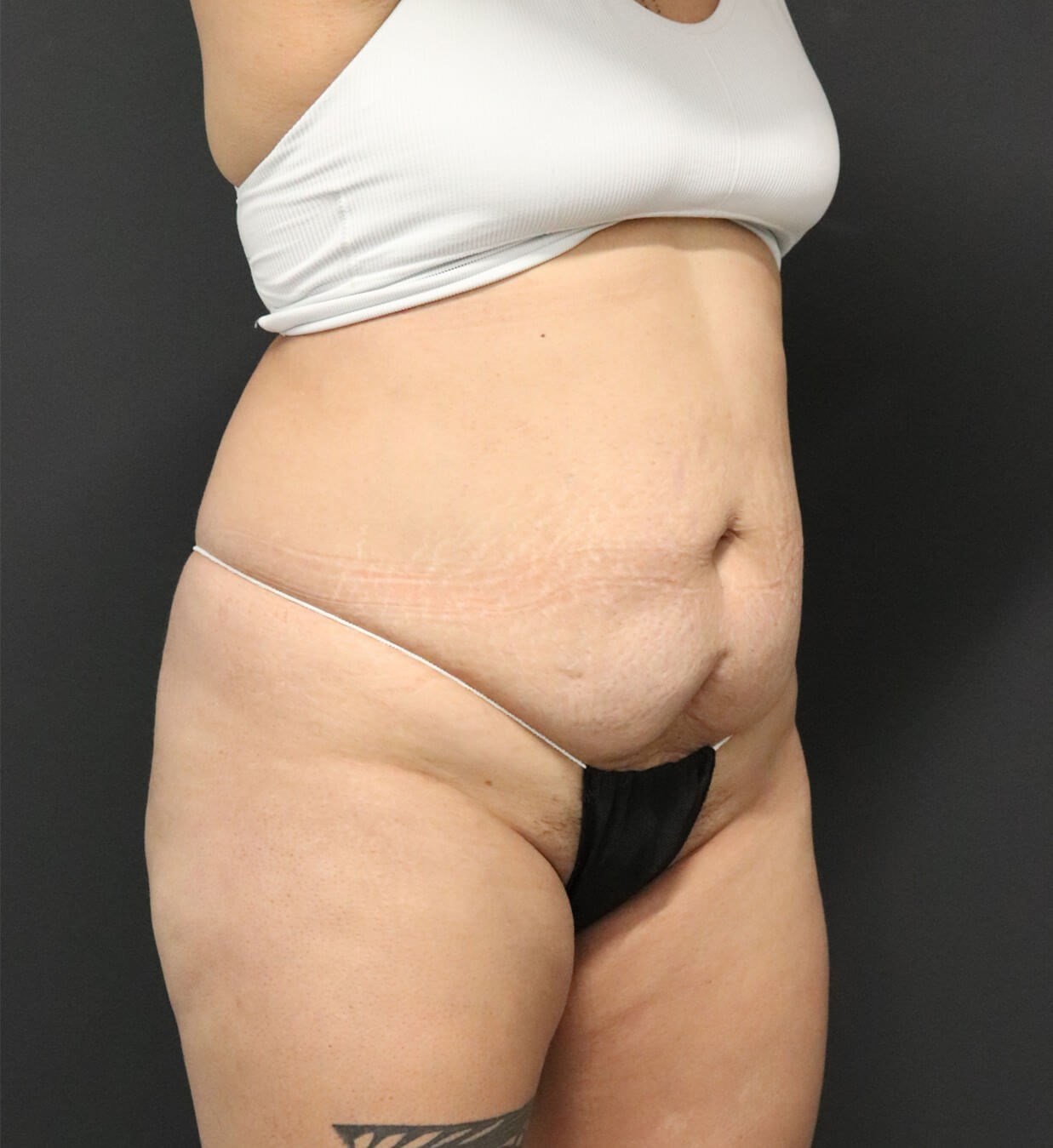 Lipo360 and Lipoabdominoplasty Before