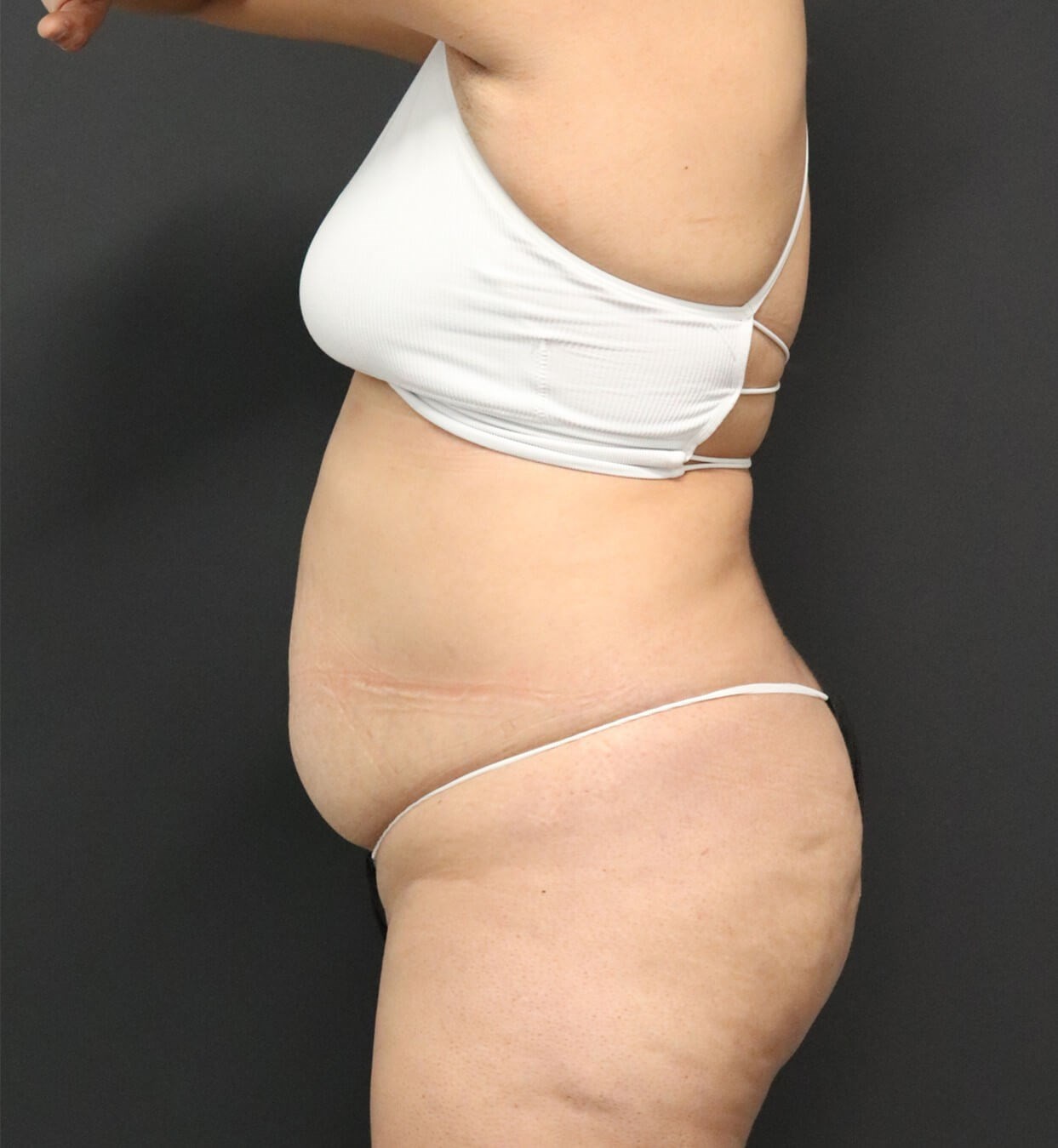 Lipo360 and Lipoabdominoplasty Before