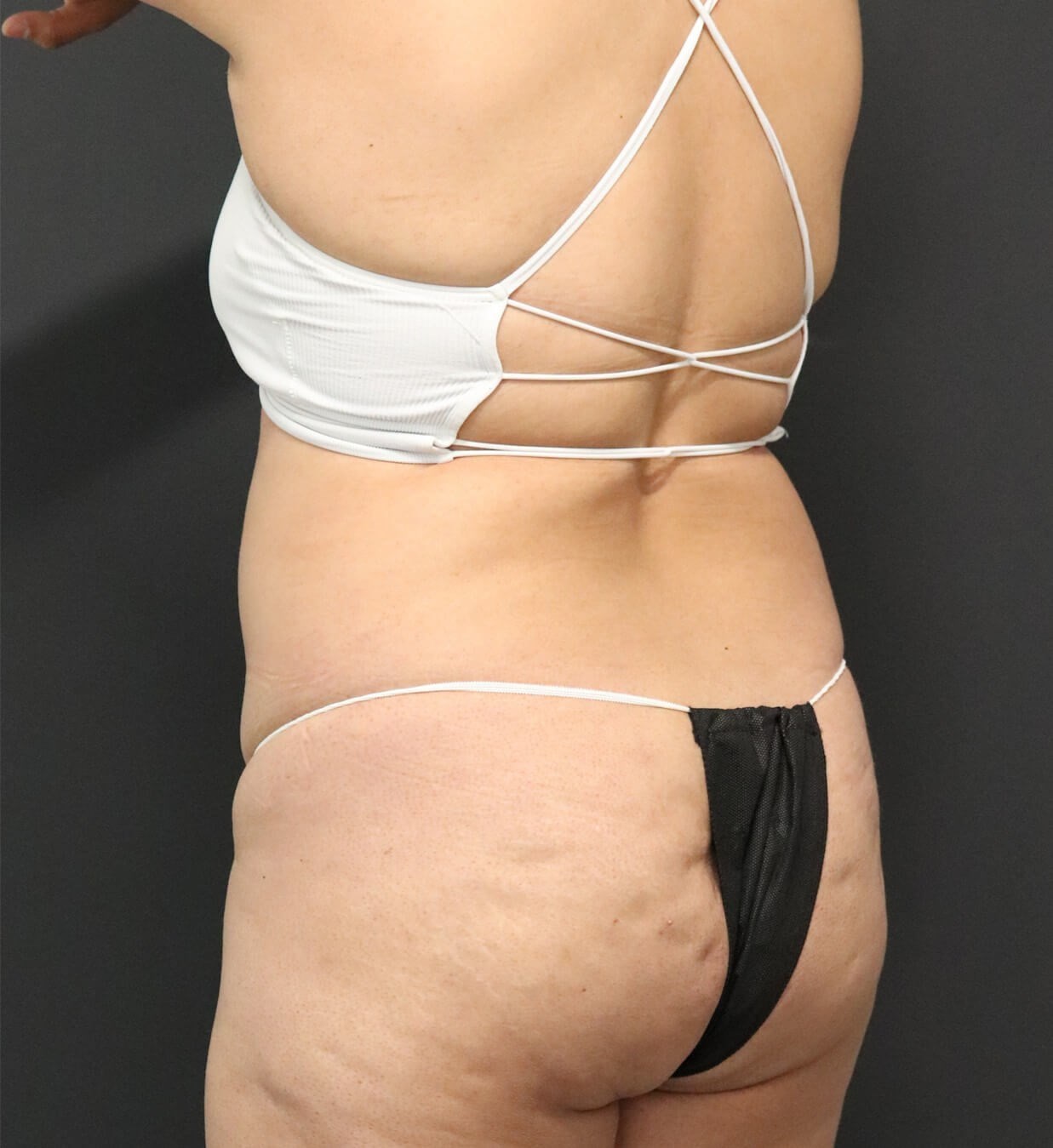 Lipo360 and Lipoabdominoplasty Before