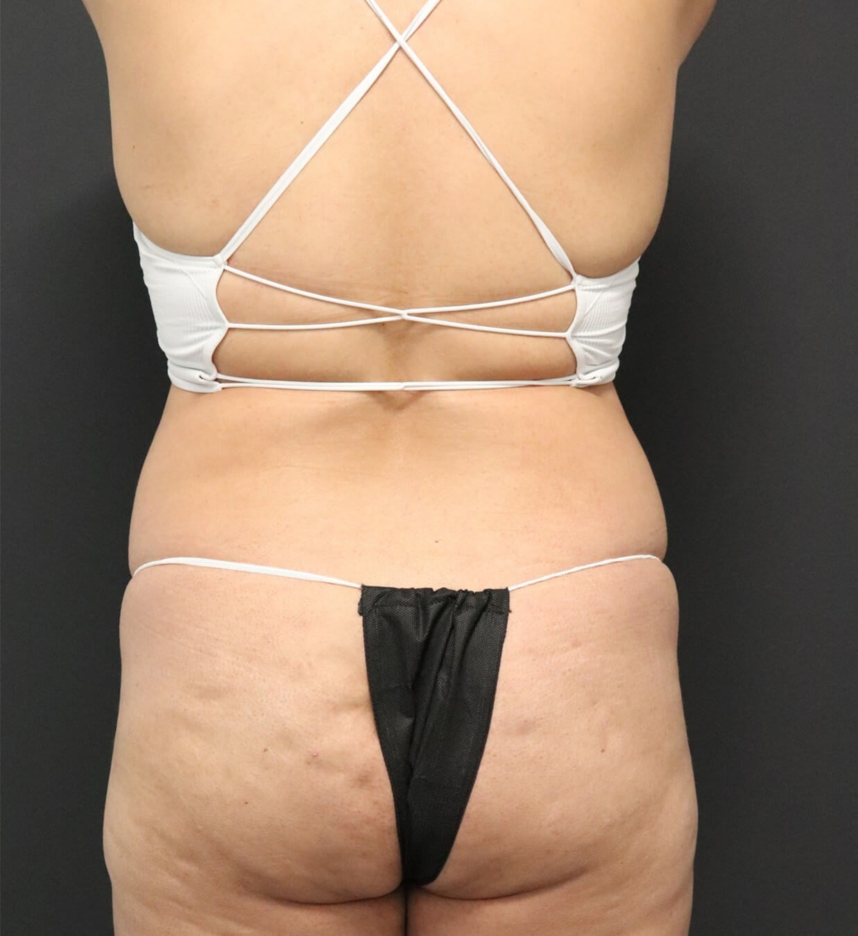Lipo360 and Lipoabdominoplasty Before