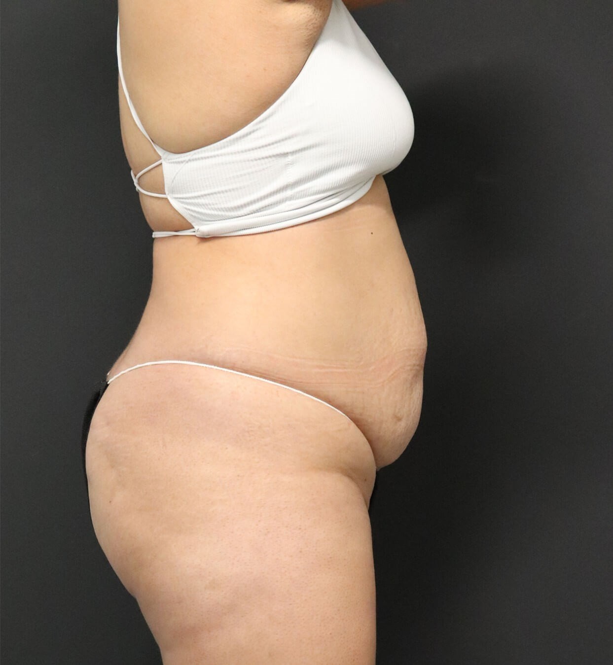 Lipo360 and Lipoabdominoplasty Before