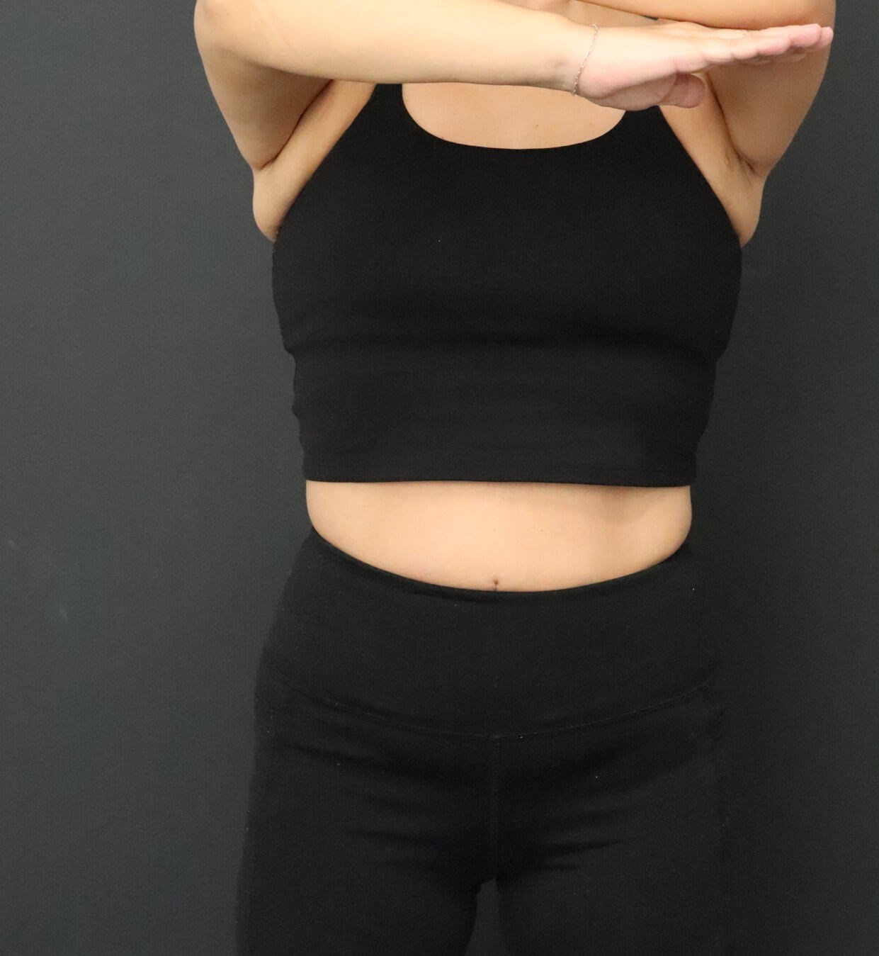 Weight loss with Semaglutide After