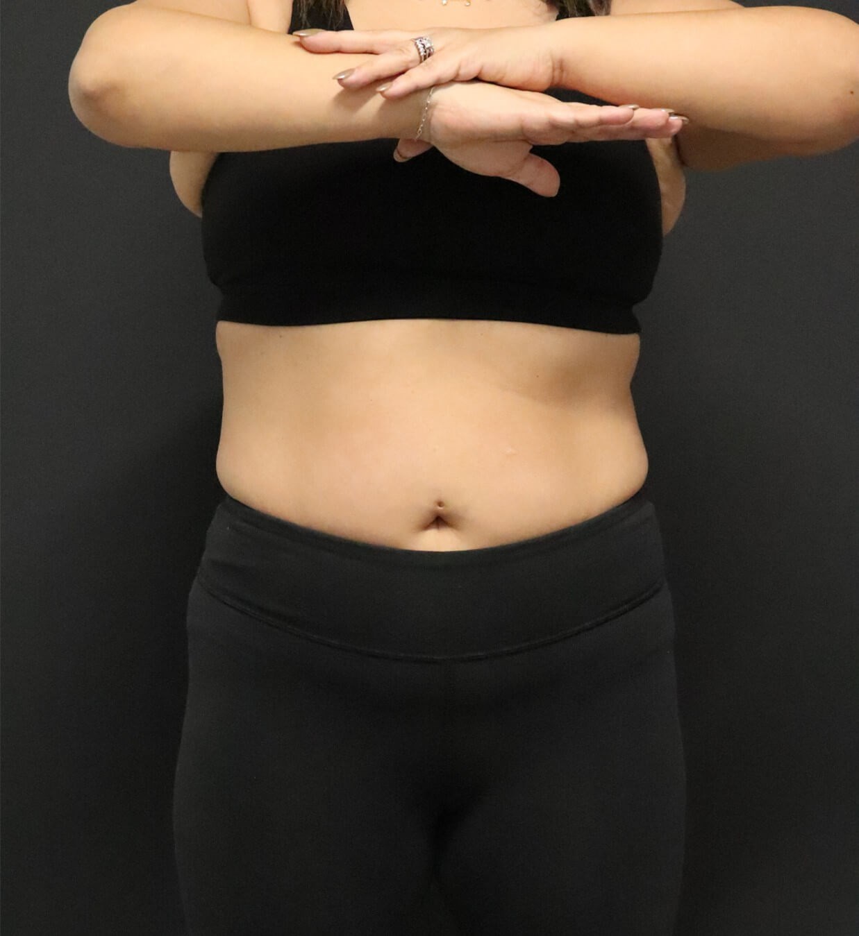 Weight loss with Semaglutide Before