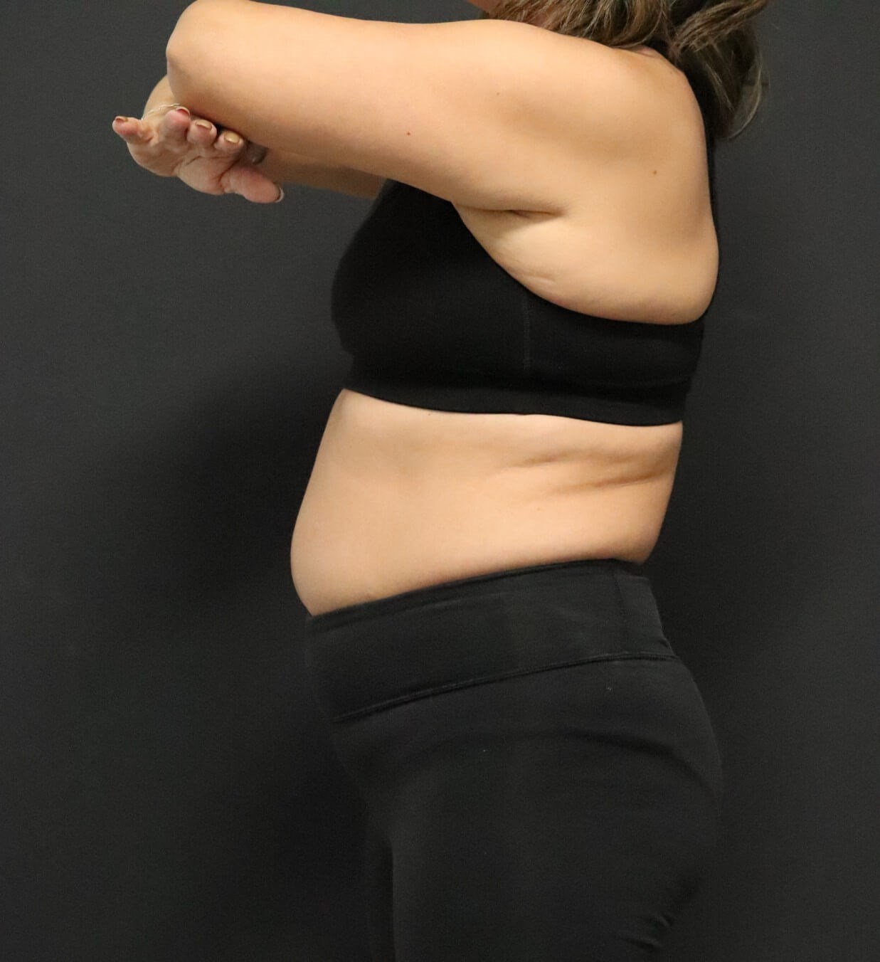 Weight loss with Semaglutide Before