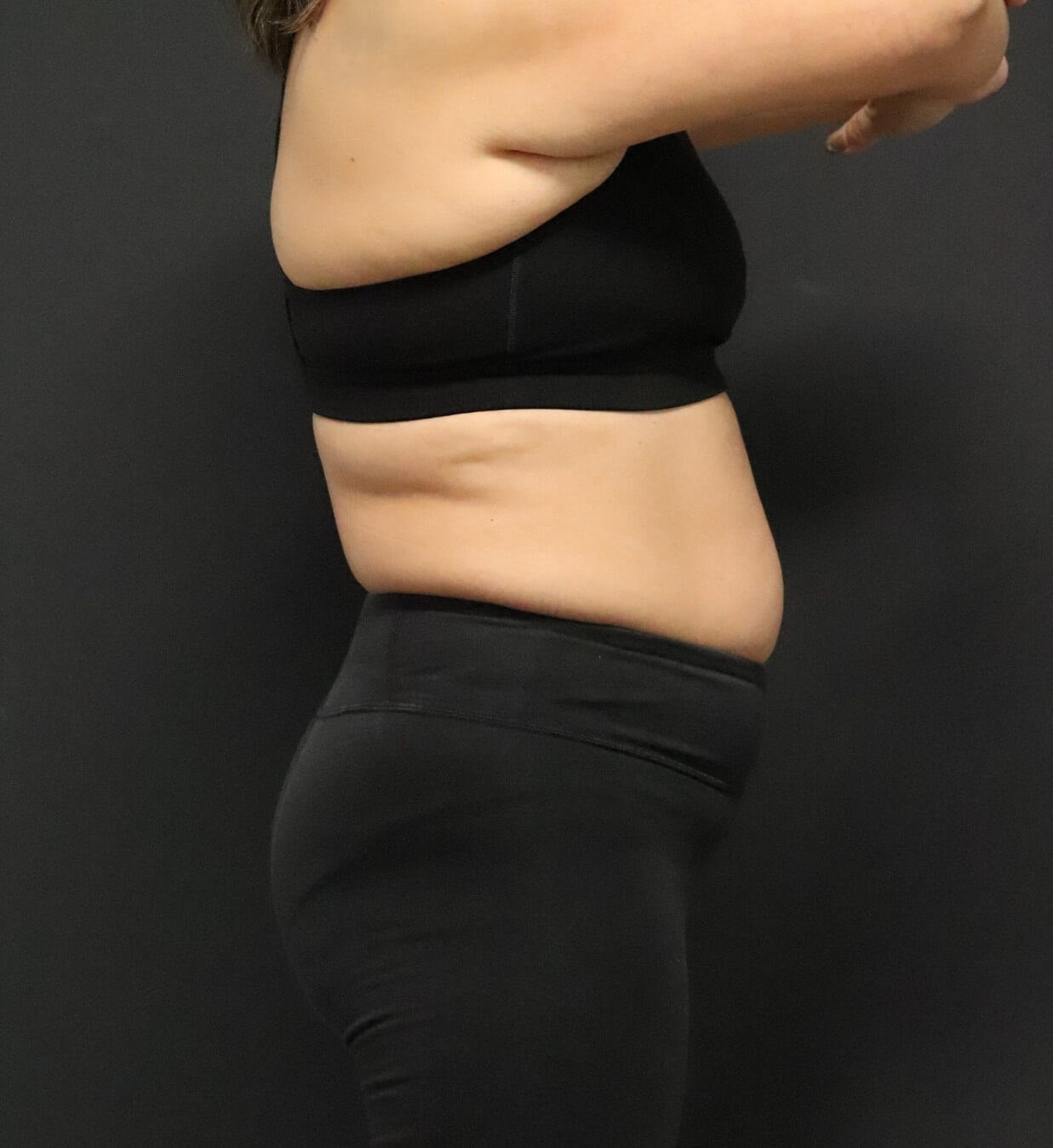 Weight loss with Semaglutide Before