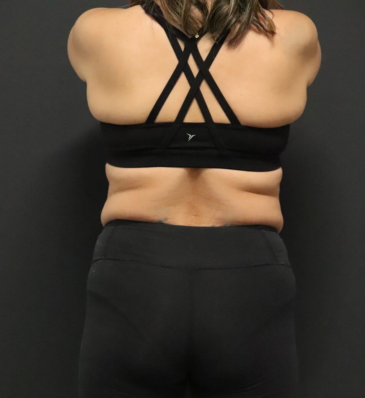 Weight loss with Semaglutide Before