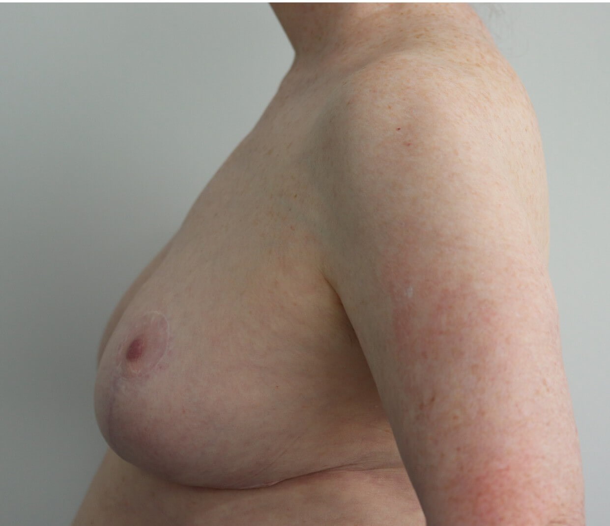 Breast Reduction in Austin TX After