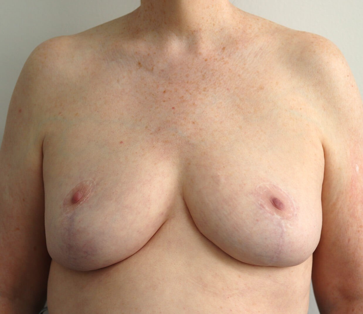 Breast Reduction in Austin TX After