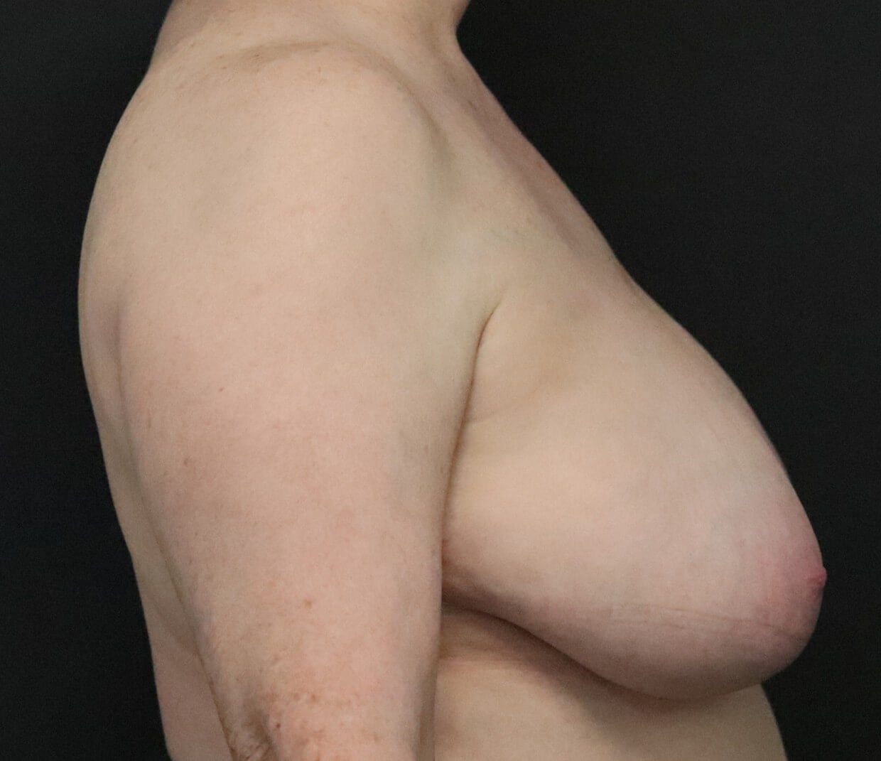 Breast Reduction in Austin TX Before