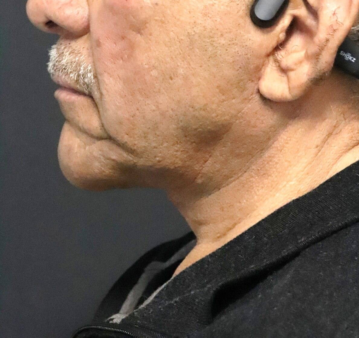 T to Z Direct Necklift in Male After