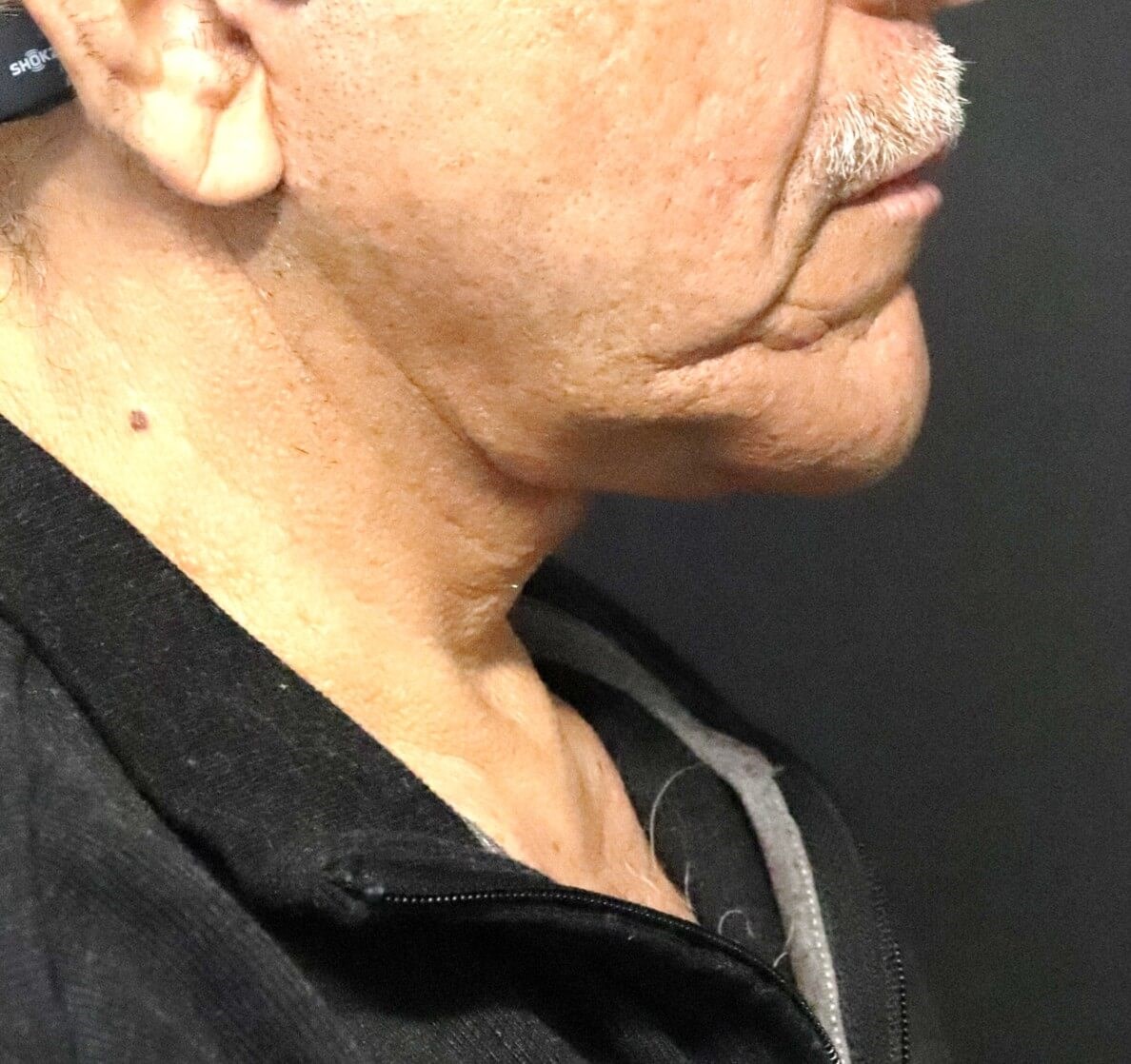 T to Z Direct Necklift in Male After