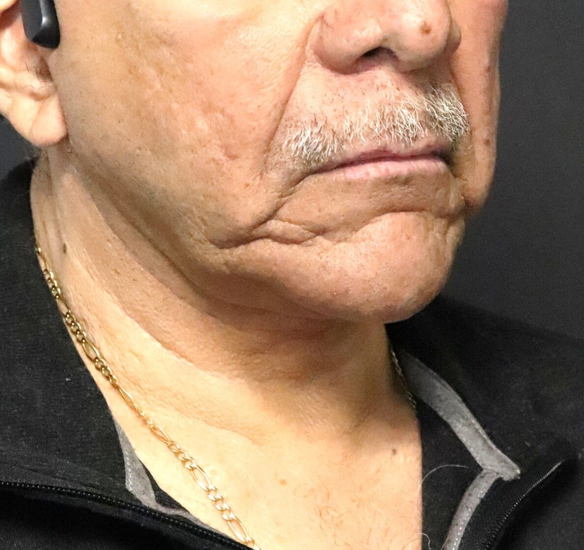 T to Z Direct Necklift in Male After