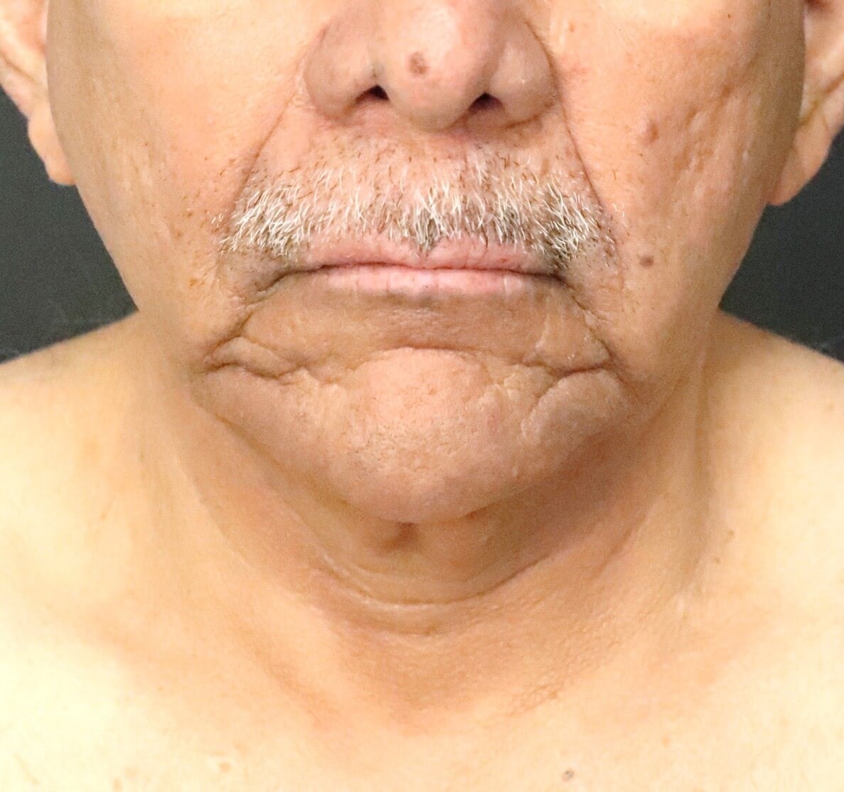 T to Z Direct Necklift in Male Before