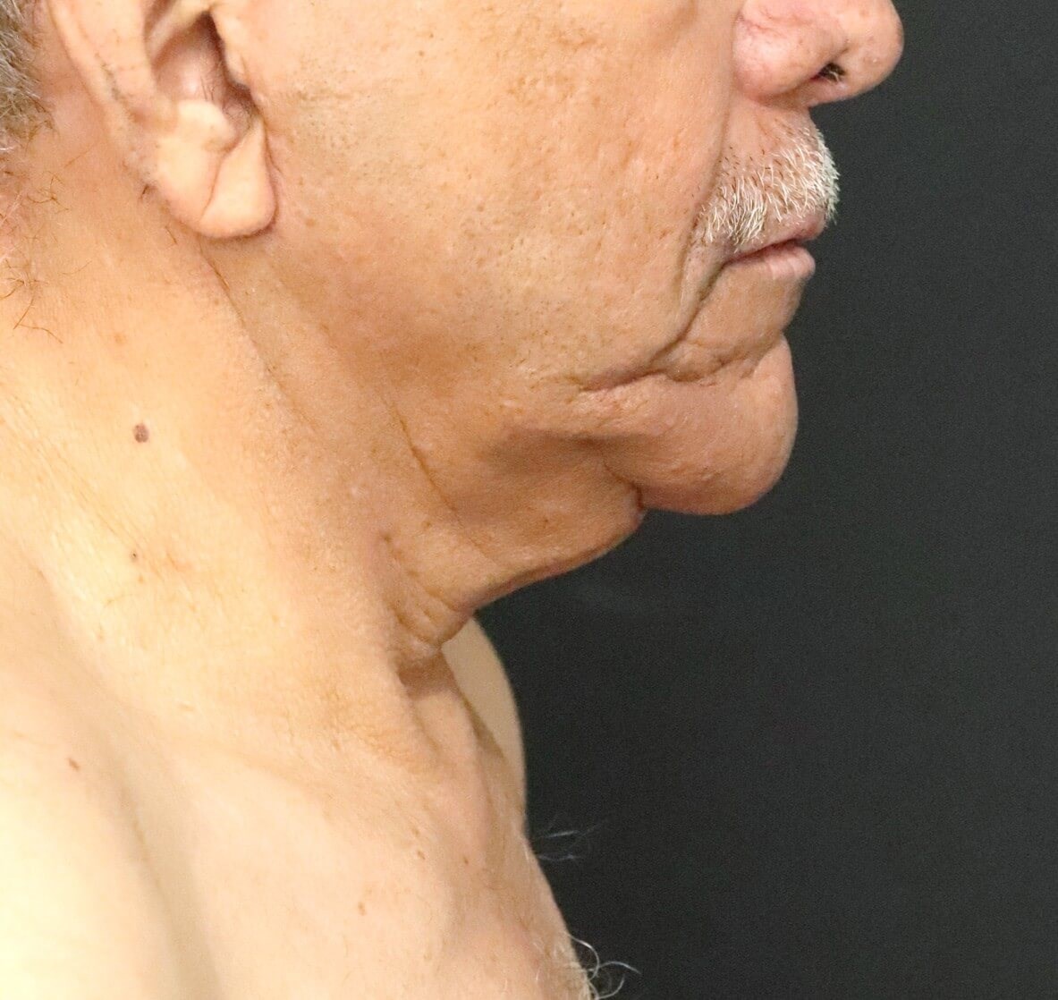 T to Z Direct Necklift in Male Before
